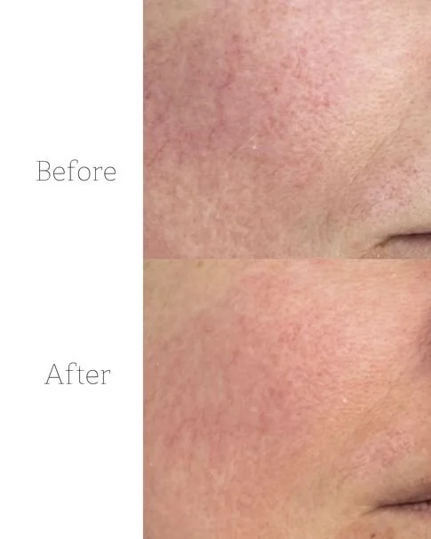 Microneedling Hamburg – Professionelle Gesichtsbehandlung am Jungfernstieg