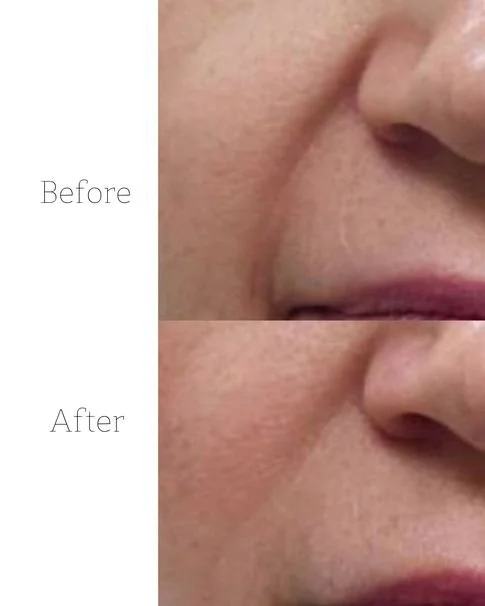 Microneedling Hamburg – Innovation für strahlende Haut