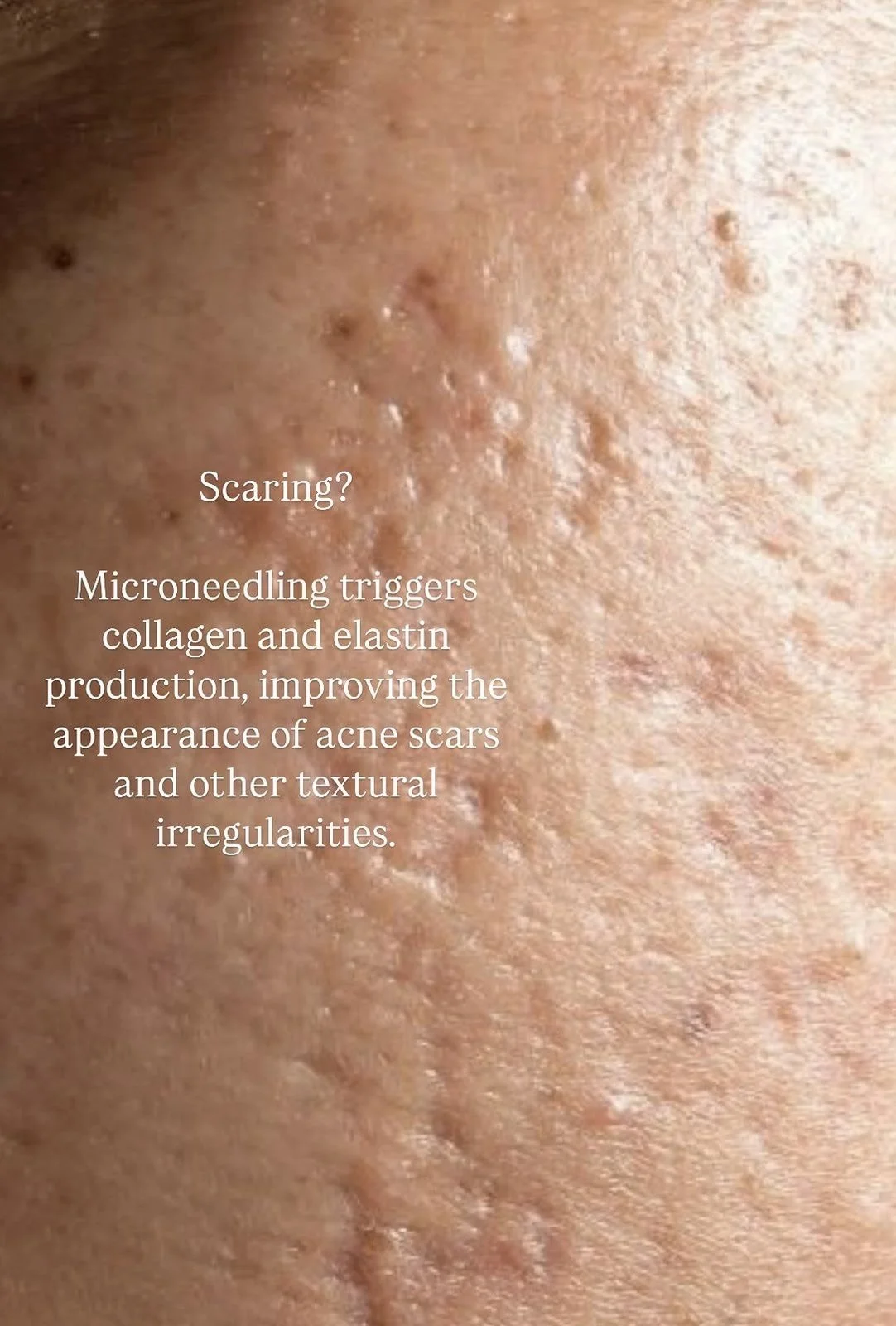 Microneedling in Hamburg gegen Falten, Aknenarben &amp; große Poren – Vorher-Nachher Ergebnisse