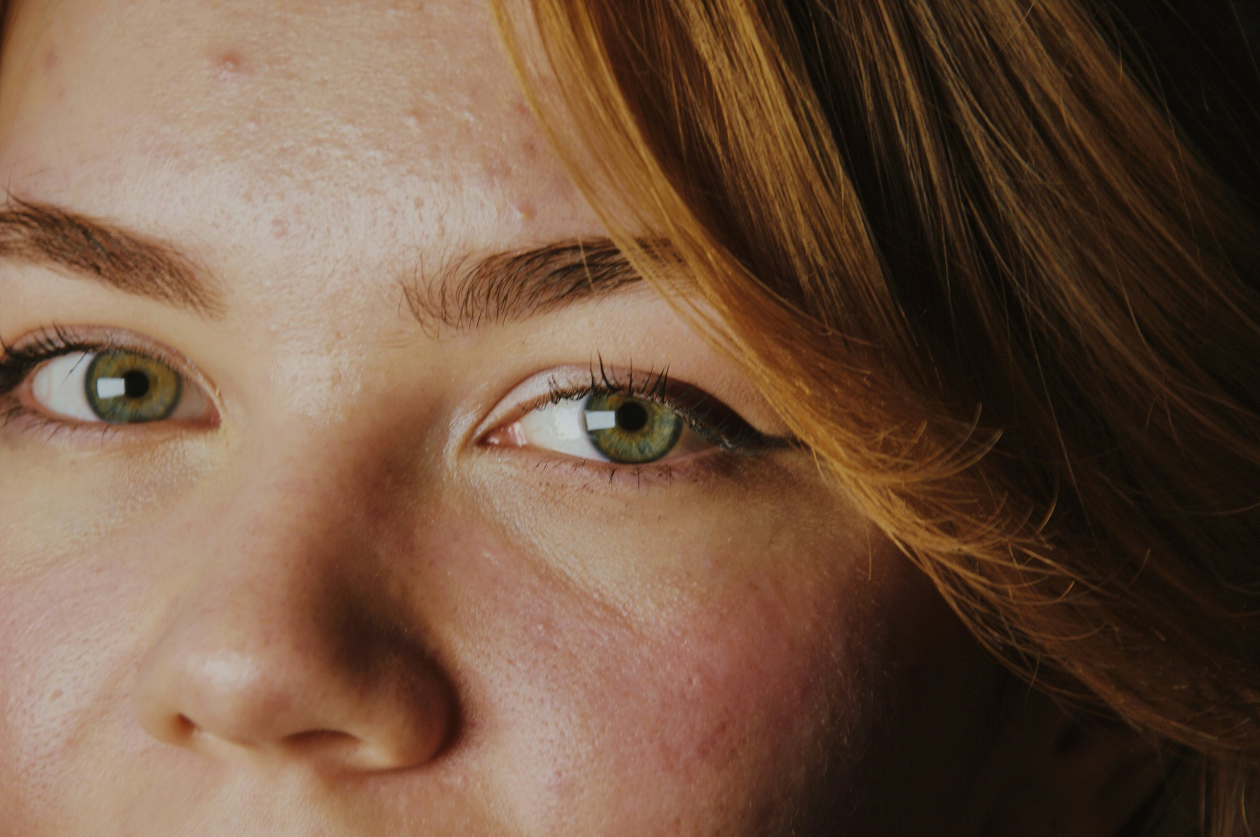 Microneedling bei Aknenarben
