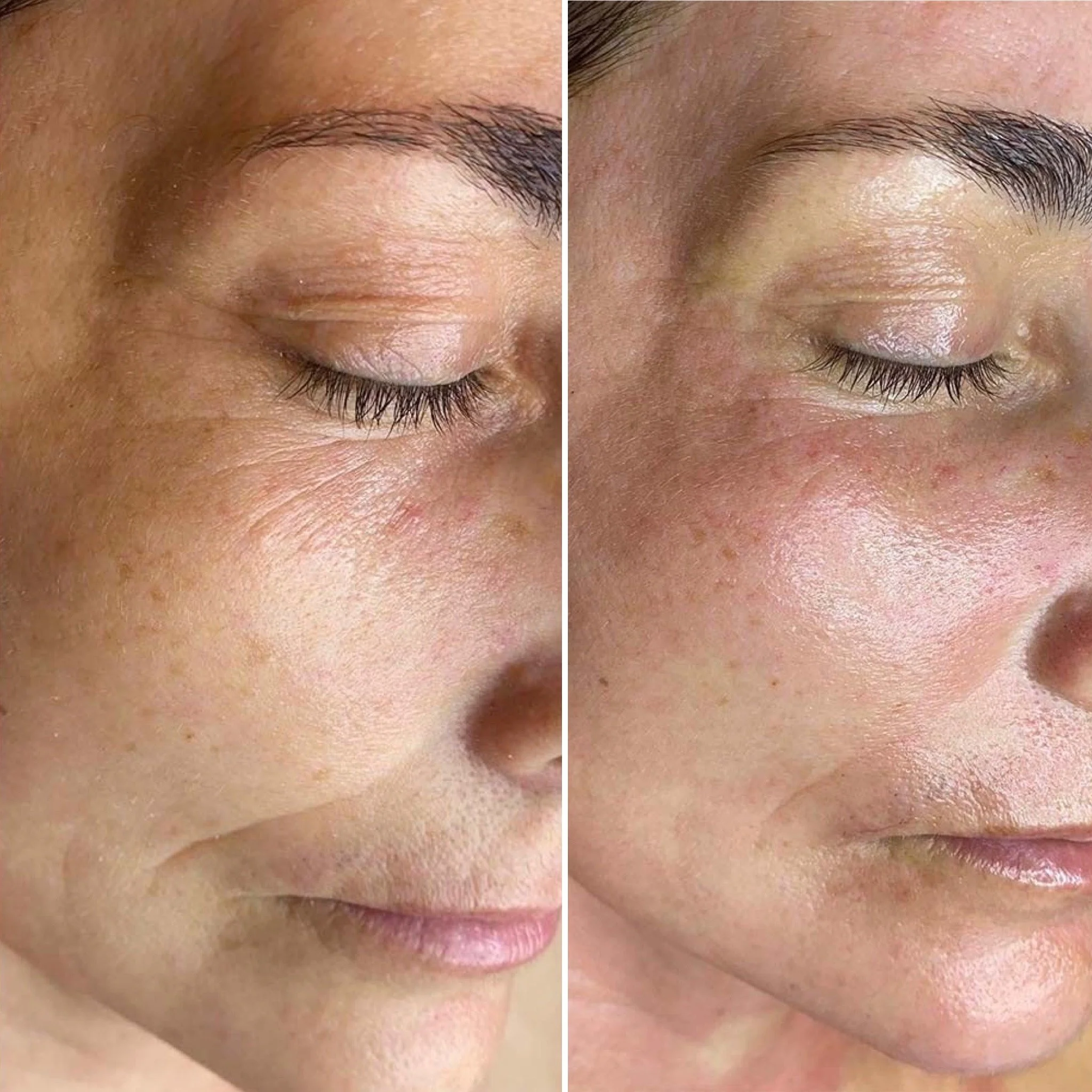 Microneedling für mehr Festigkeit, prallere Haut und Glow