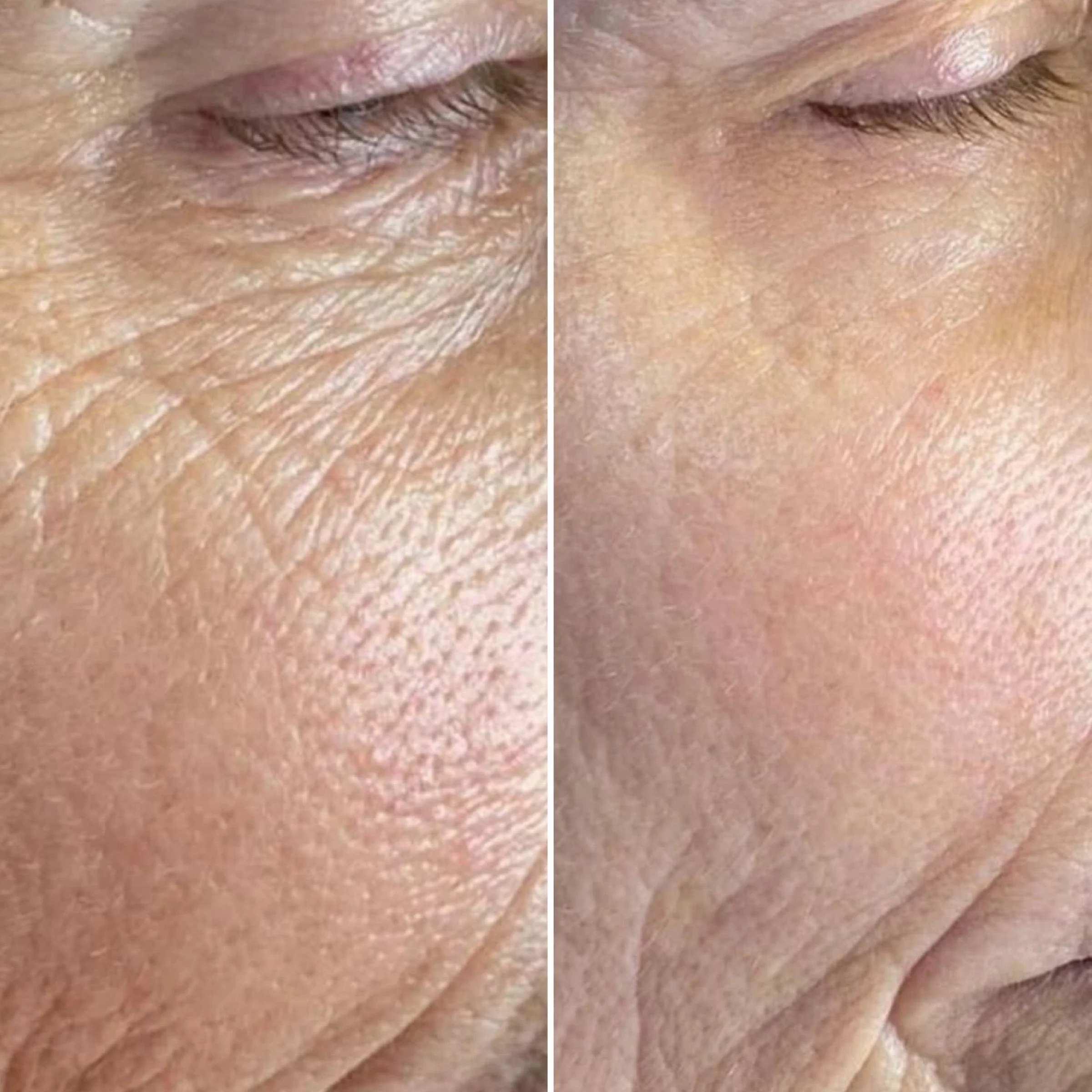 Microneedling zur Reduzierung tieferer Falten und Poren