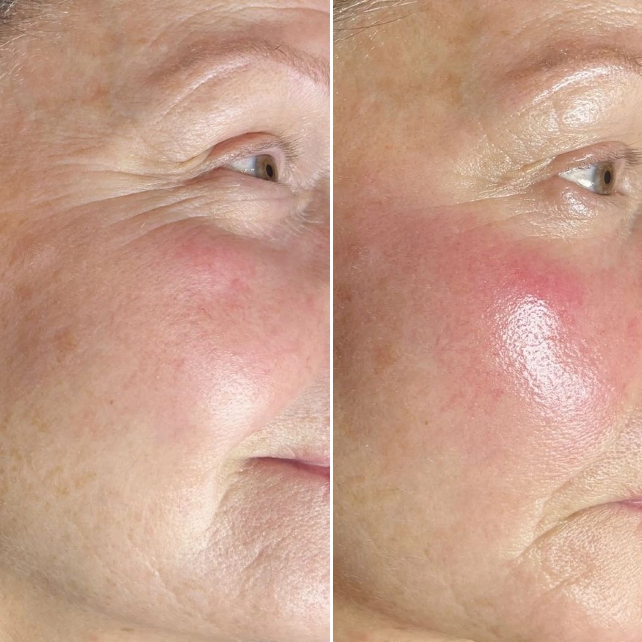 Microneedling zur Reduzierung von Falten im Augenbereich