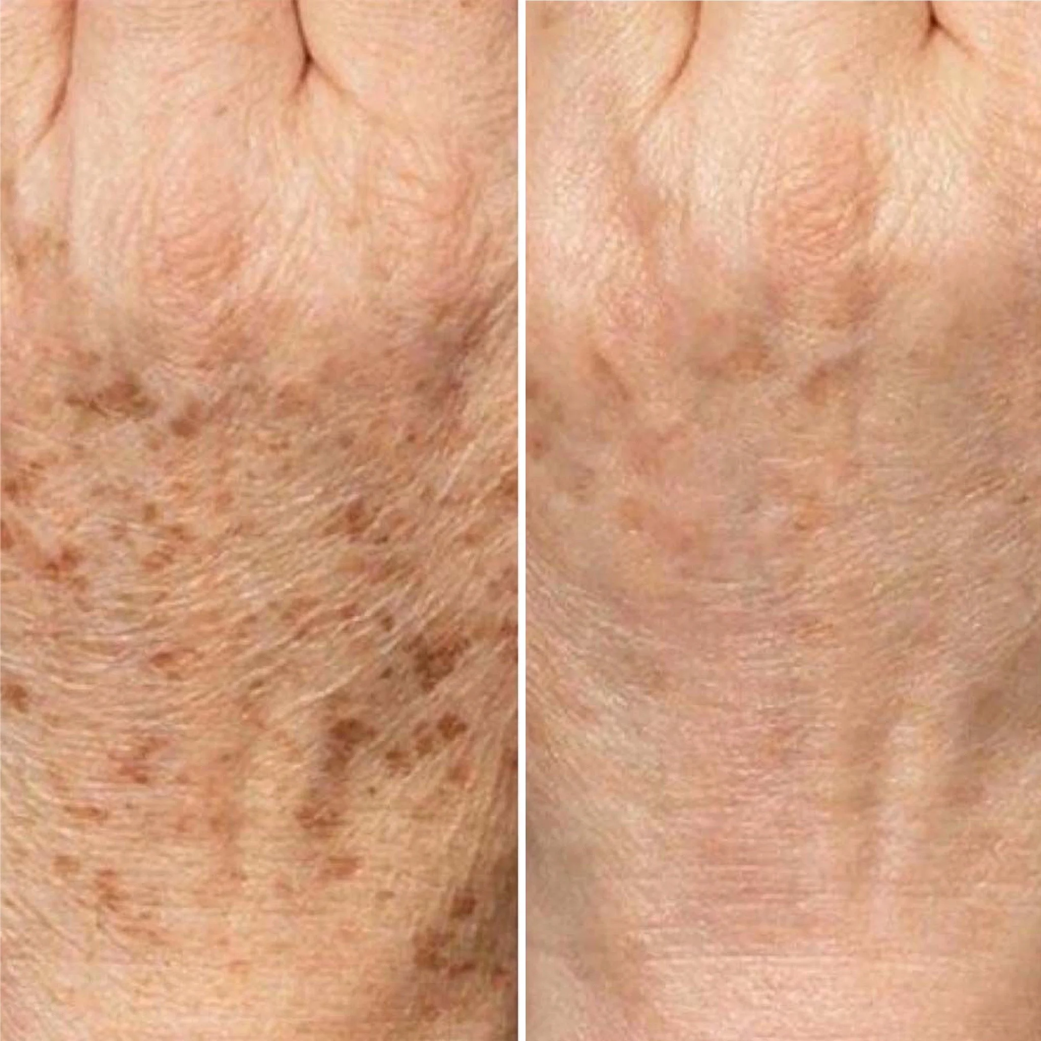 Microneedling zur Reduzierung von Altersflecken
