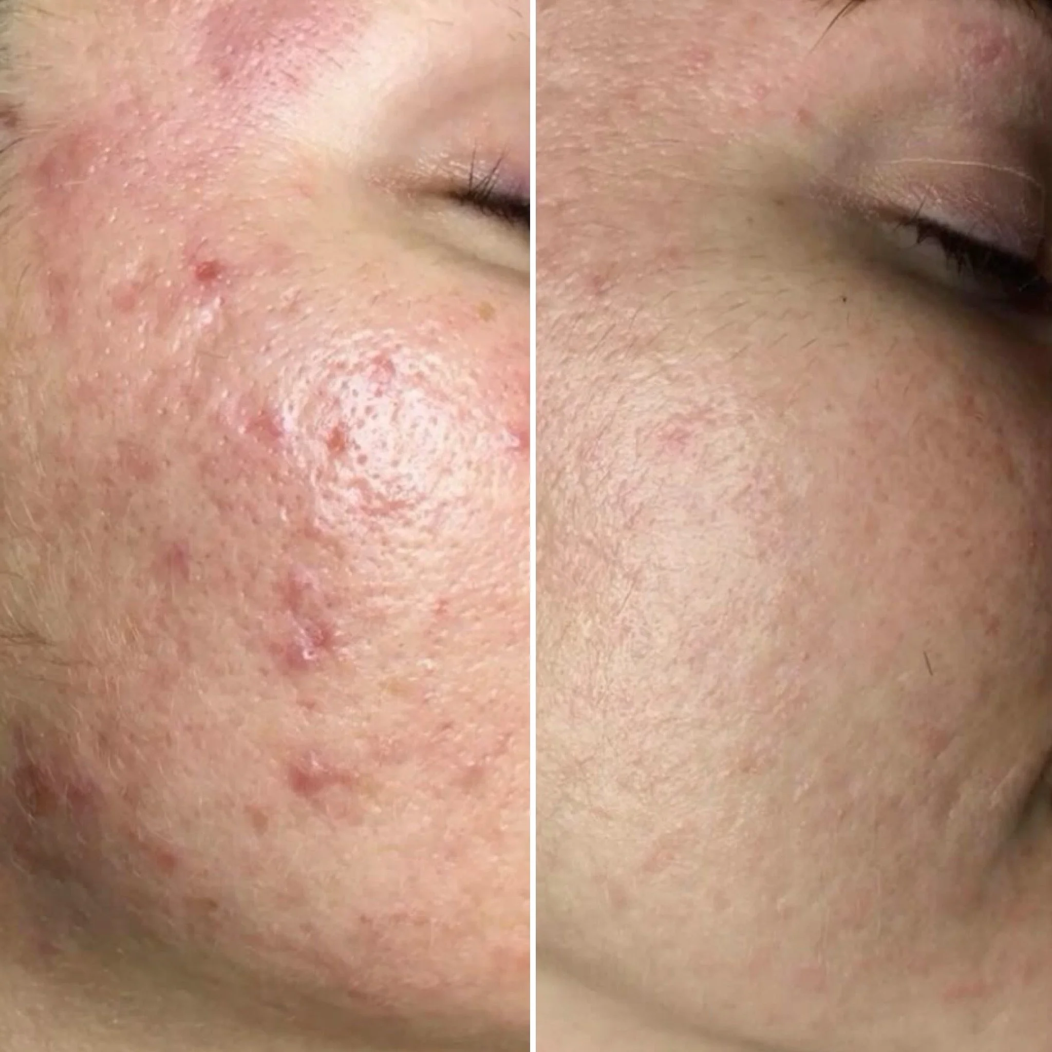 Radiofrequenz-Microneedling bei Aknenarben – sichtbare Hautverbesserung nach einer Behandlungskur