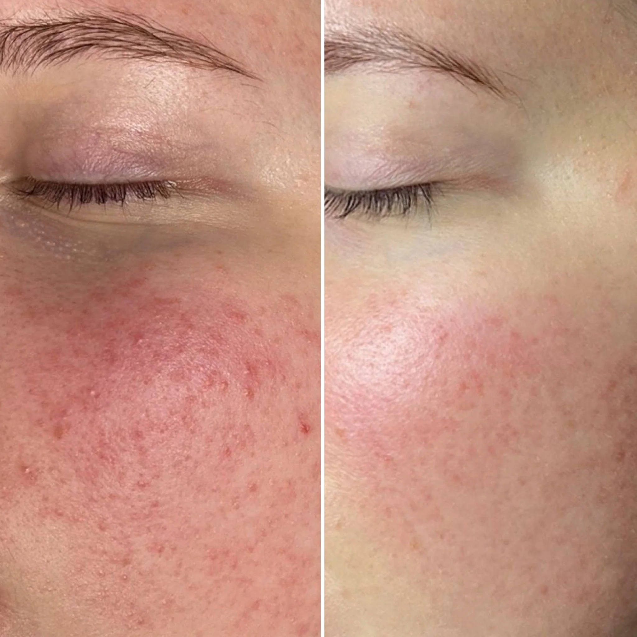 RF-Microneedling bei Rosazea – sichtbare Hautverbesserung nach der Behandlungskur
