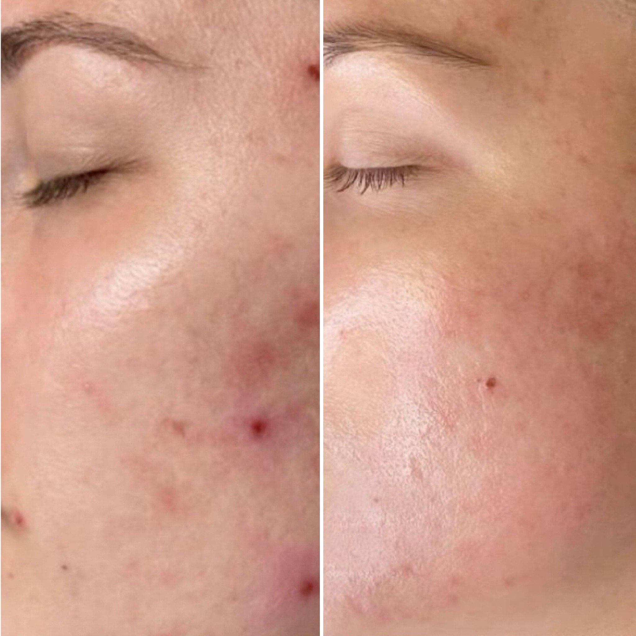RF-Microneedling bei Akne und Aknenarben – sichtbare Hautverbesserung nach der Behandlungskur