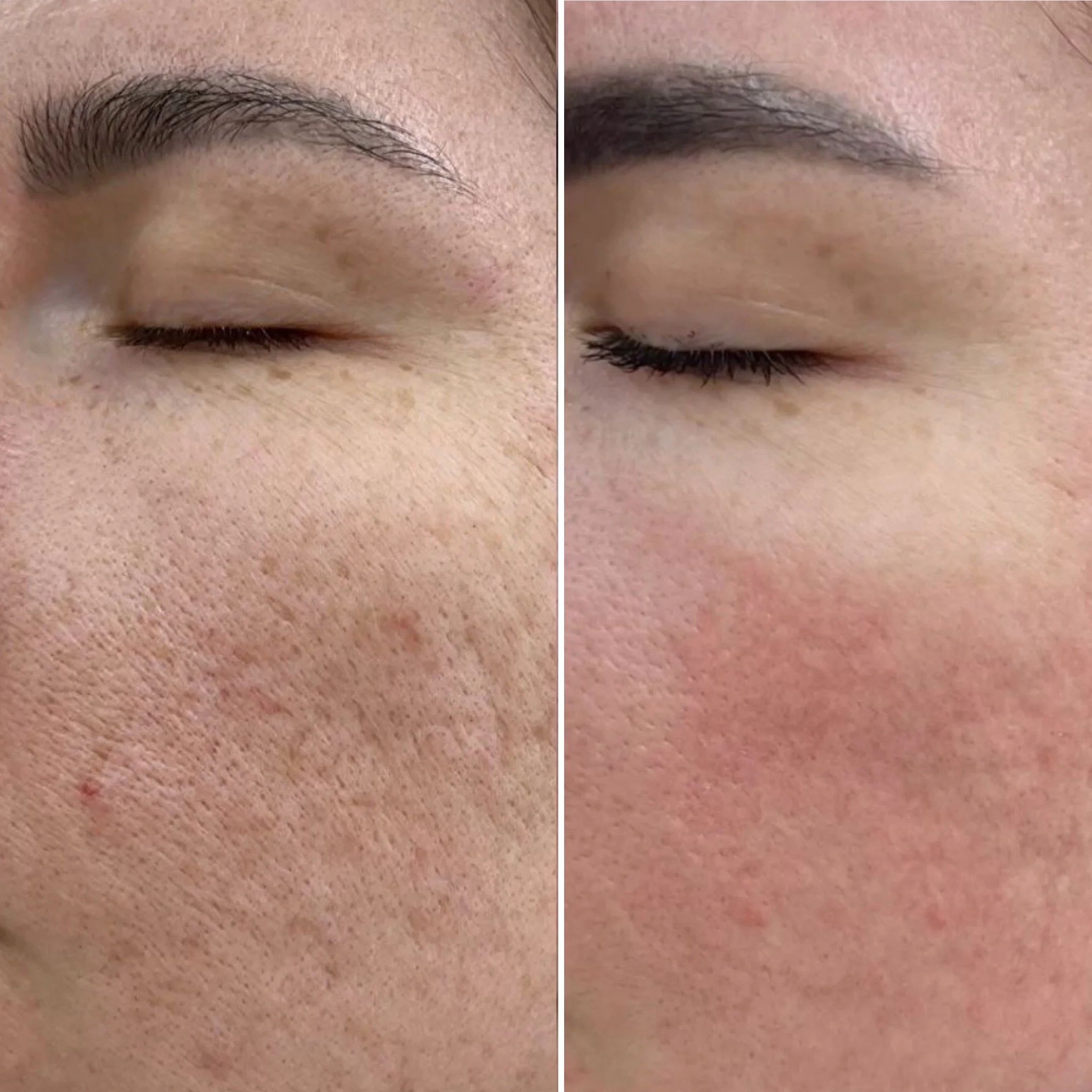 RF-Microneedling bei Akne und Aknenarben – sichtbare Hautverbesserung nach der Behandlungskur