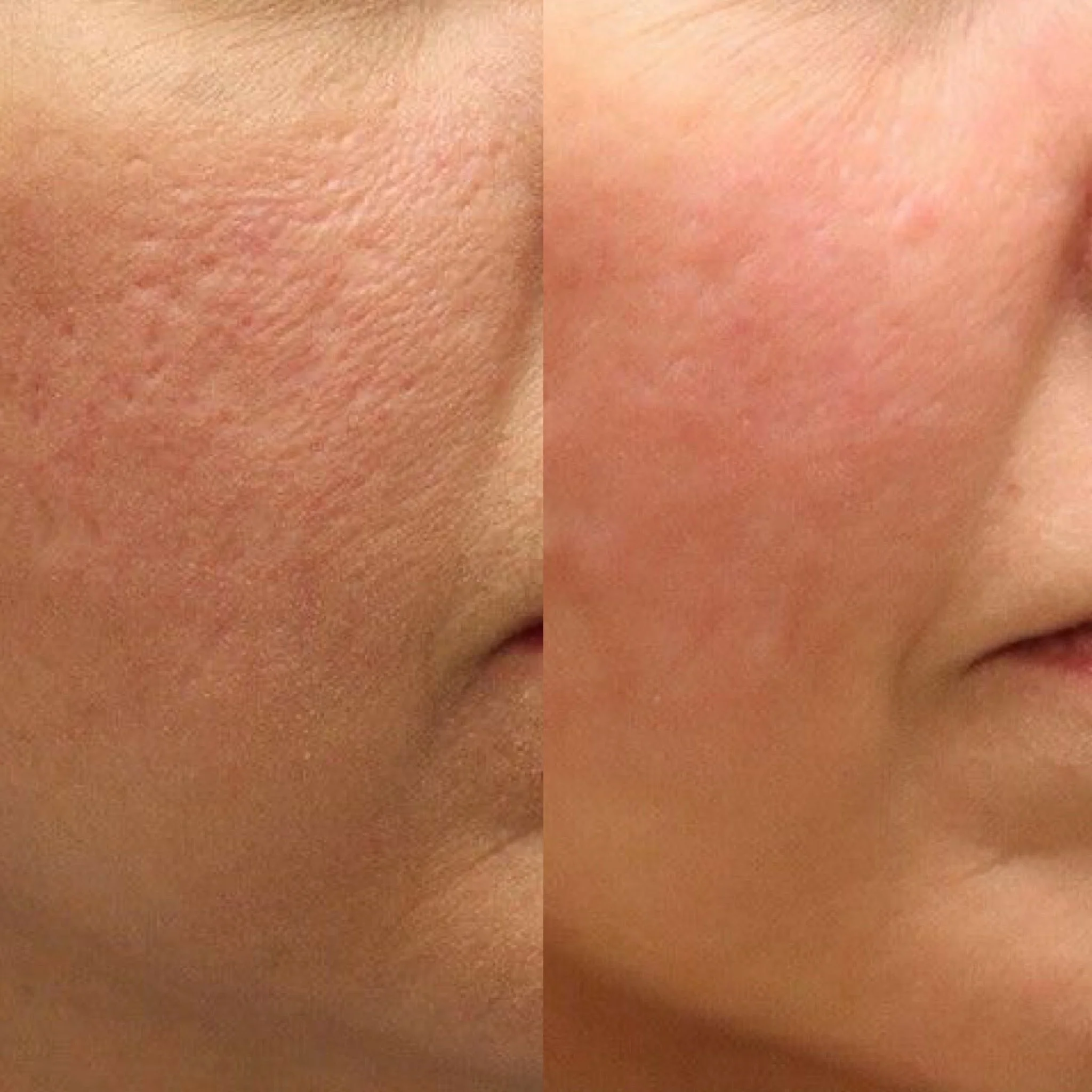 Microdermabrasion in Hamburg – Vorher &amp; Nachher für feinere Haut und einen frischen Glow