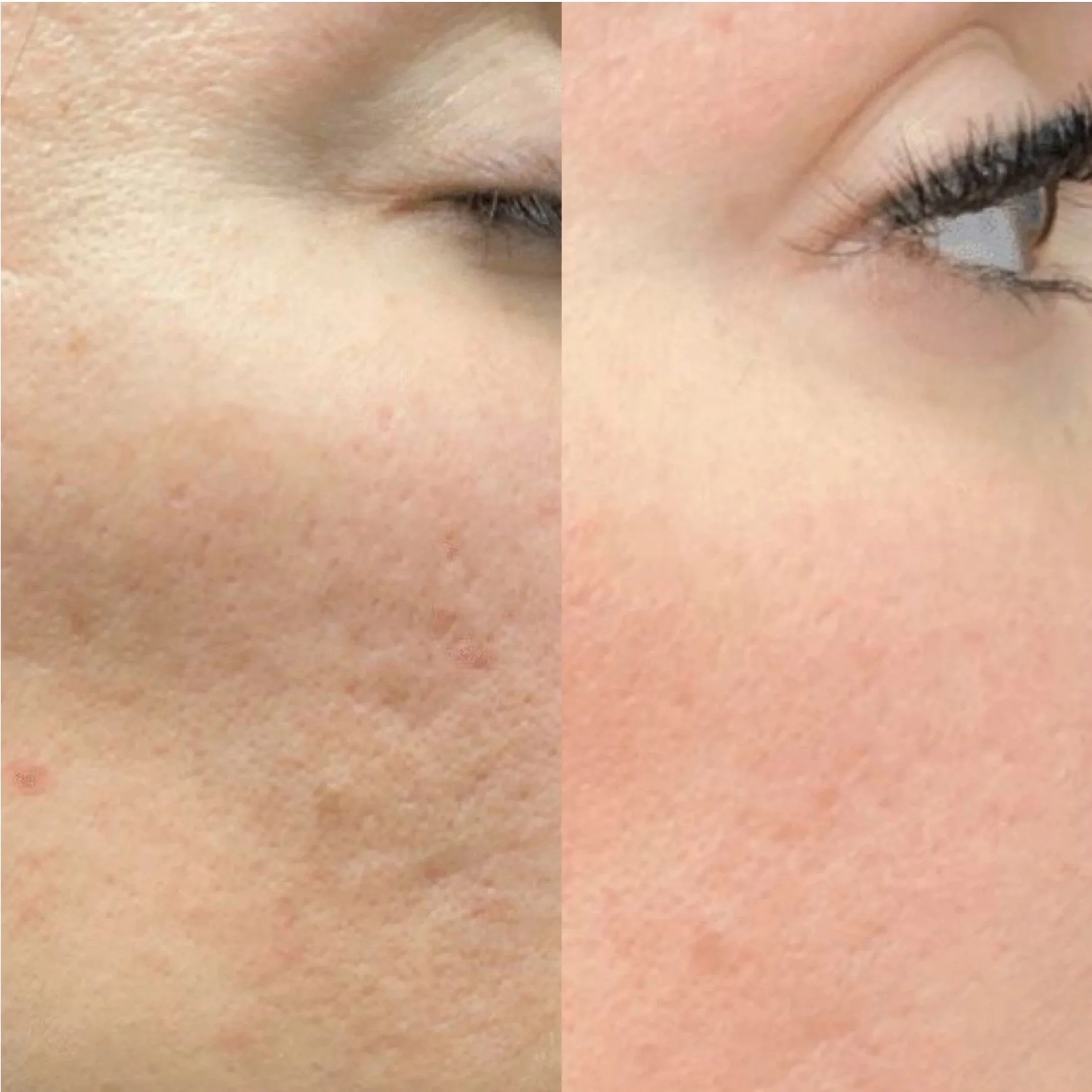 Microdermabrasion in Hamburg für glatte Haut und frischen Glow nach der Behandlung