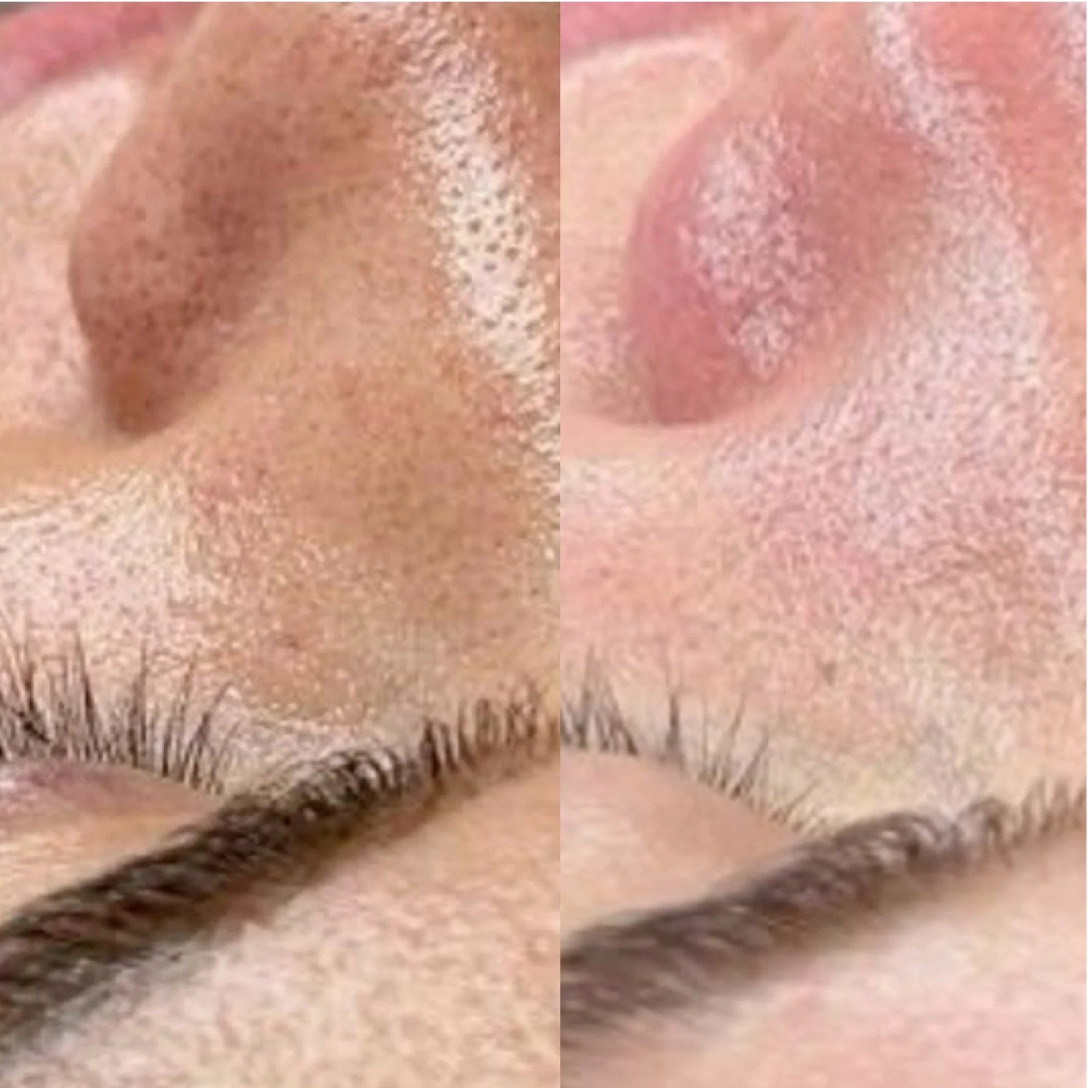 Microdermabrasion in Hamburg – Vorher &amp; Nachher für sichtbar reinere Haut