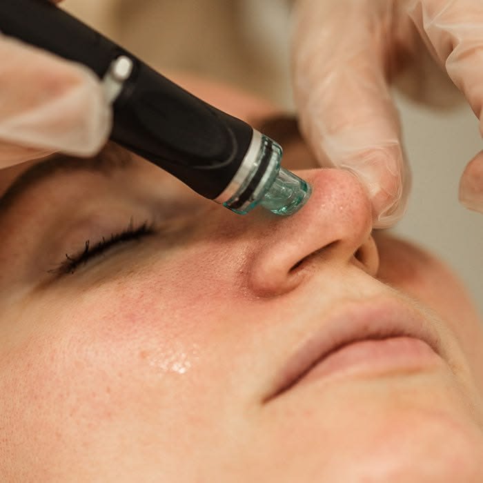 Hydrafacial Behandlung zur Tiefenreinigung der Gesichtshaut in einem Kosmetikstudio in Hamburg