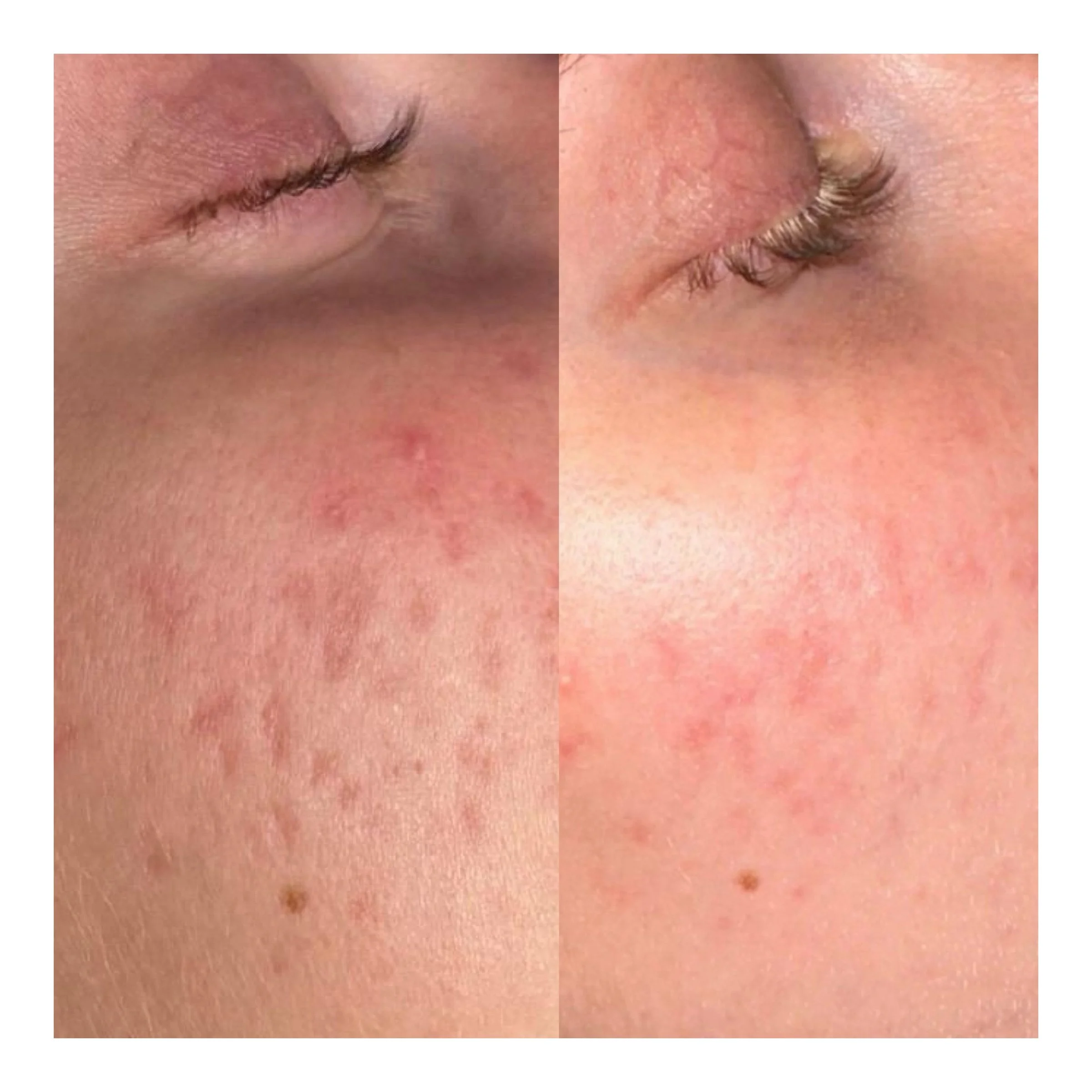 Microneedling in Hamburg zur sichtbaren Reduktion von Aknenarben und Verbesserung des Hautbilds