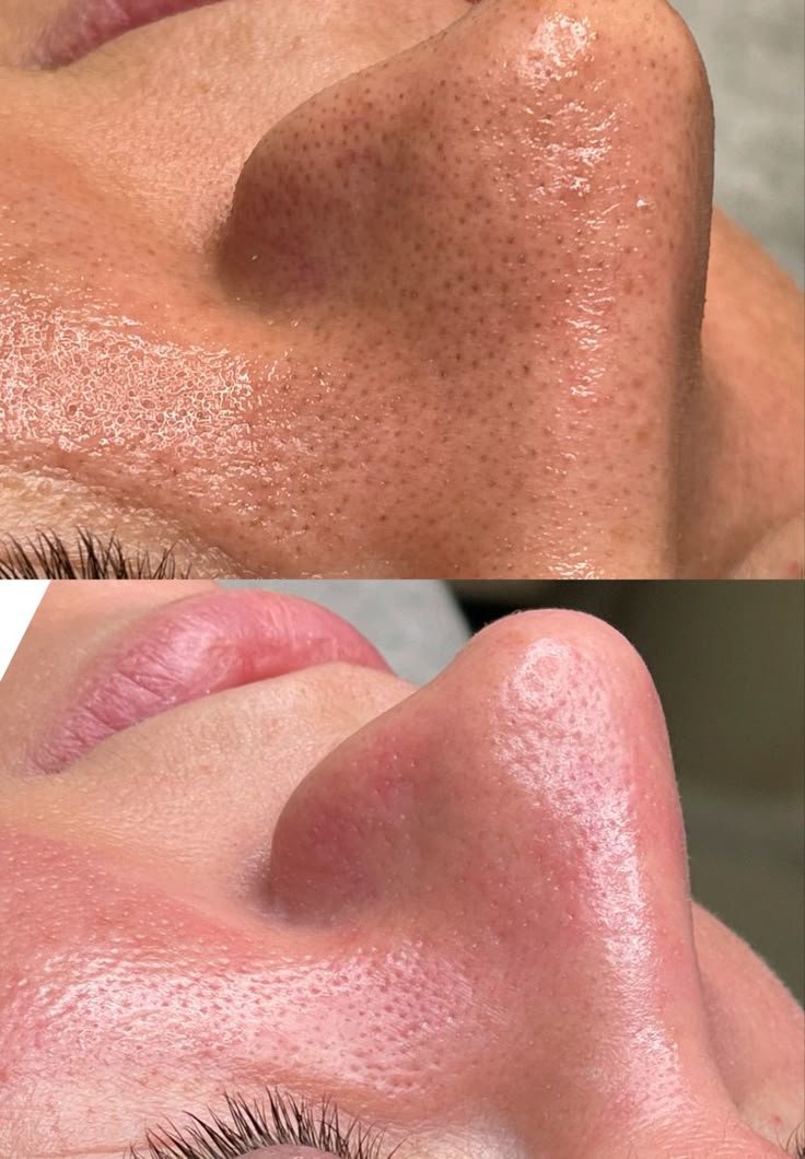 Vorher Nachher Vergleich nach Hydrafacial Behandlung mit strahlender Haut und verfeinertem Hautbild