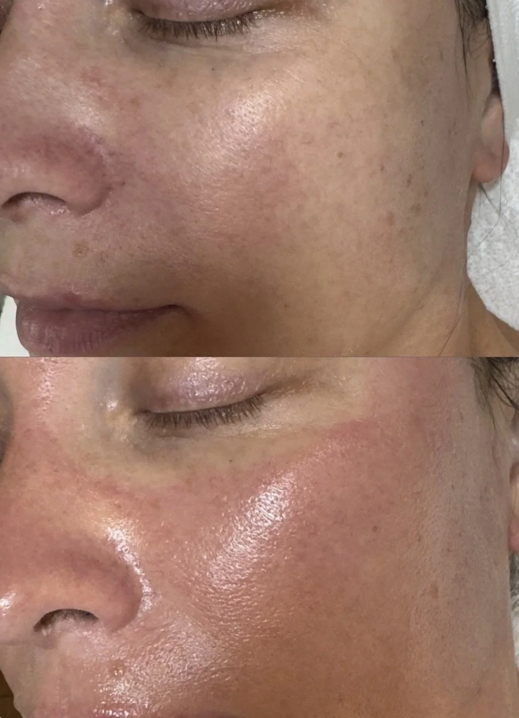 Hydrafacial in Hamburg vorher nachher