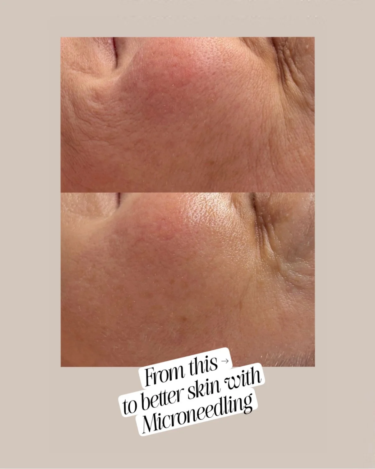Vorher-Nachher Ergebnis nach einer Microneedling-Kur in Hamburg bei Elena Antonova Skin Health – sichtbar glattere Haut, verfeinerte Poren und ein ebenmäßiger, strahlender Teint.