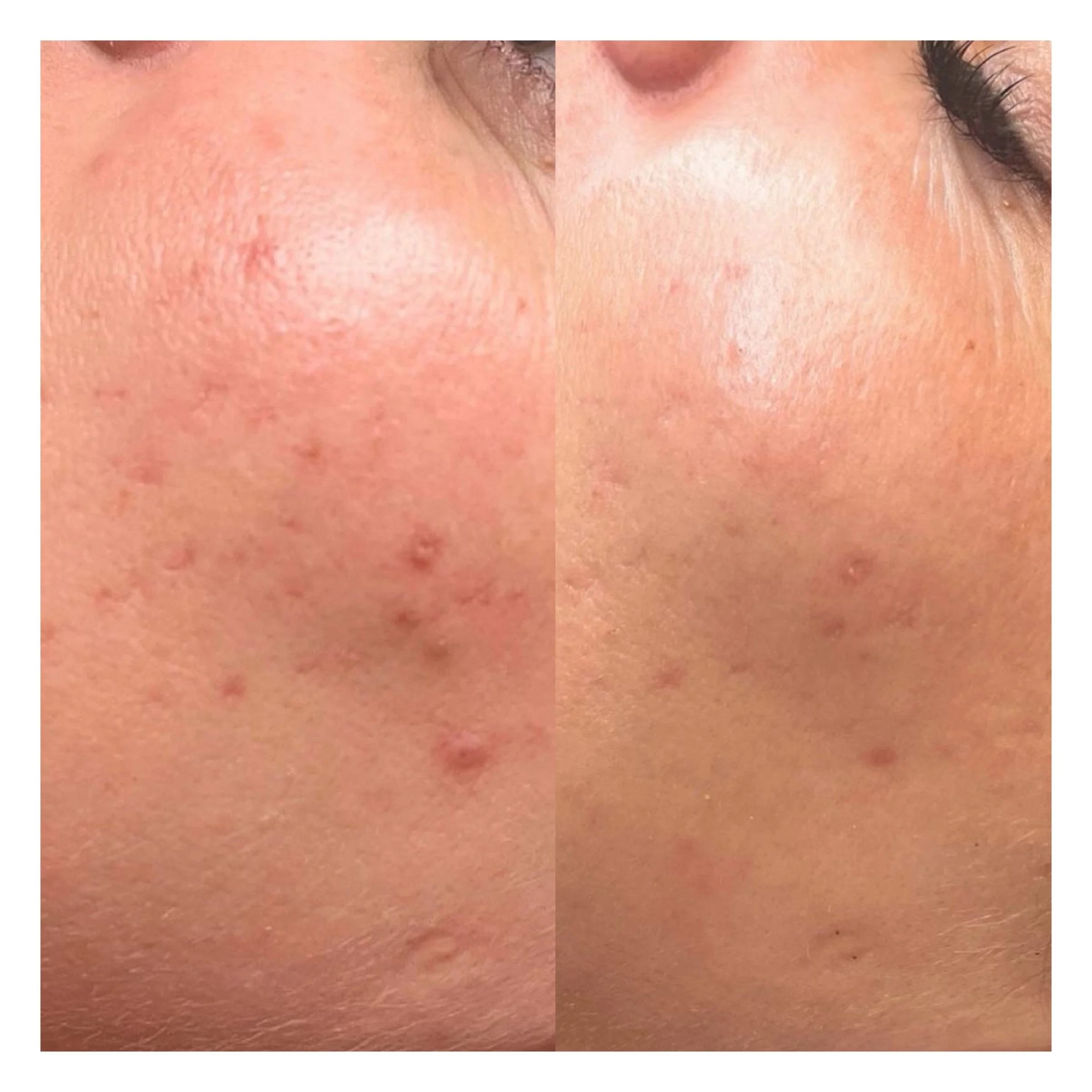 Radiofrequenz Microneedling Hamburg Ergebnis mit reinerer Haut und weniger Unreinheiten