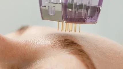 Radiofrequenz Microneedling zur Hautstraffung und Verbesserung von Hautstruktur