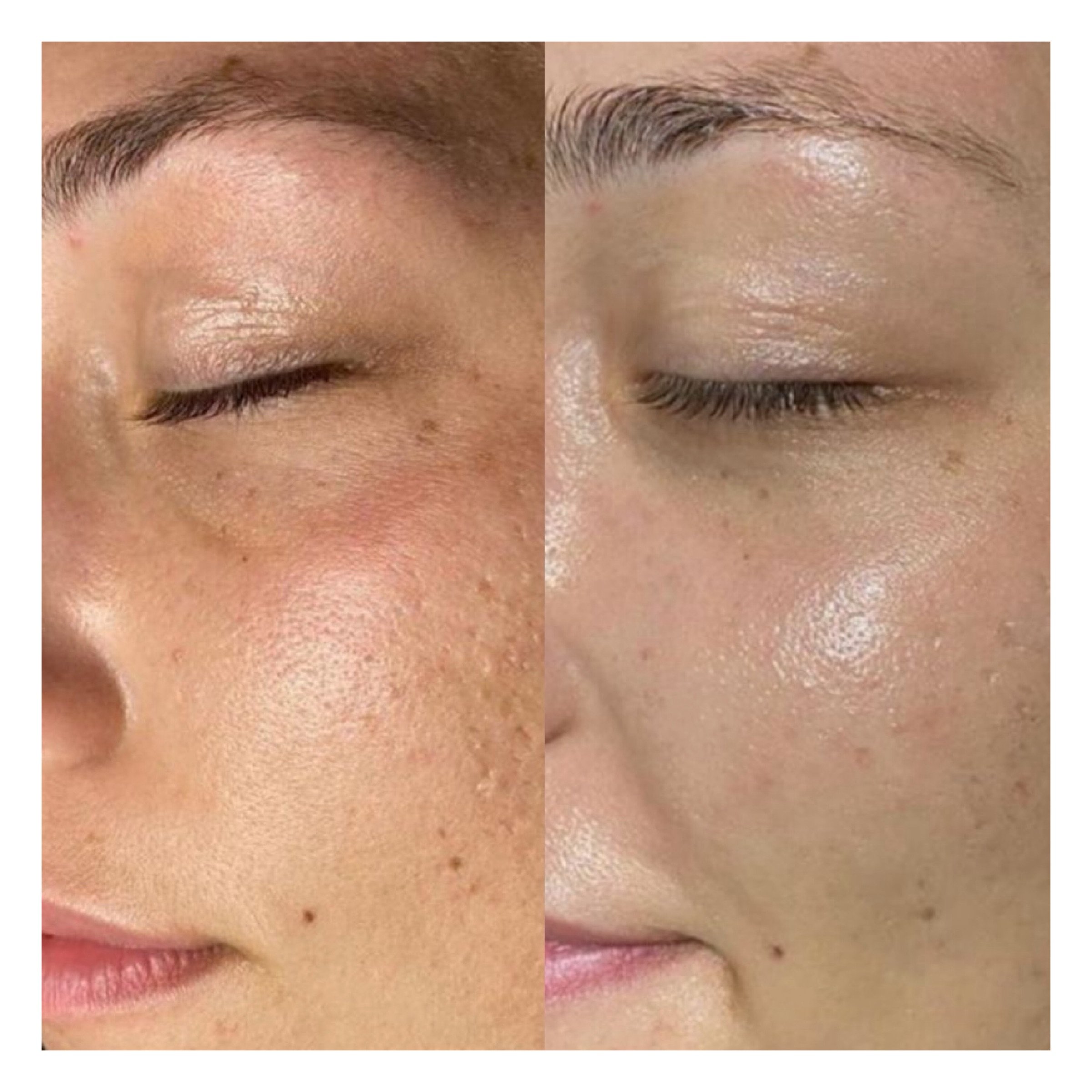Hydrafacial Hamburg sichtbares Ergebnis mit mehr Ausstrahlung