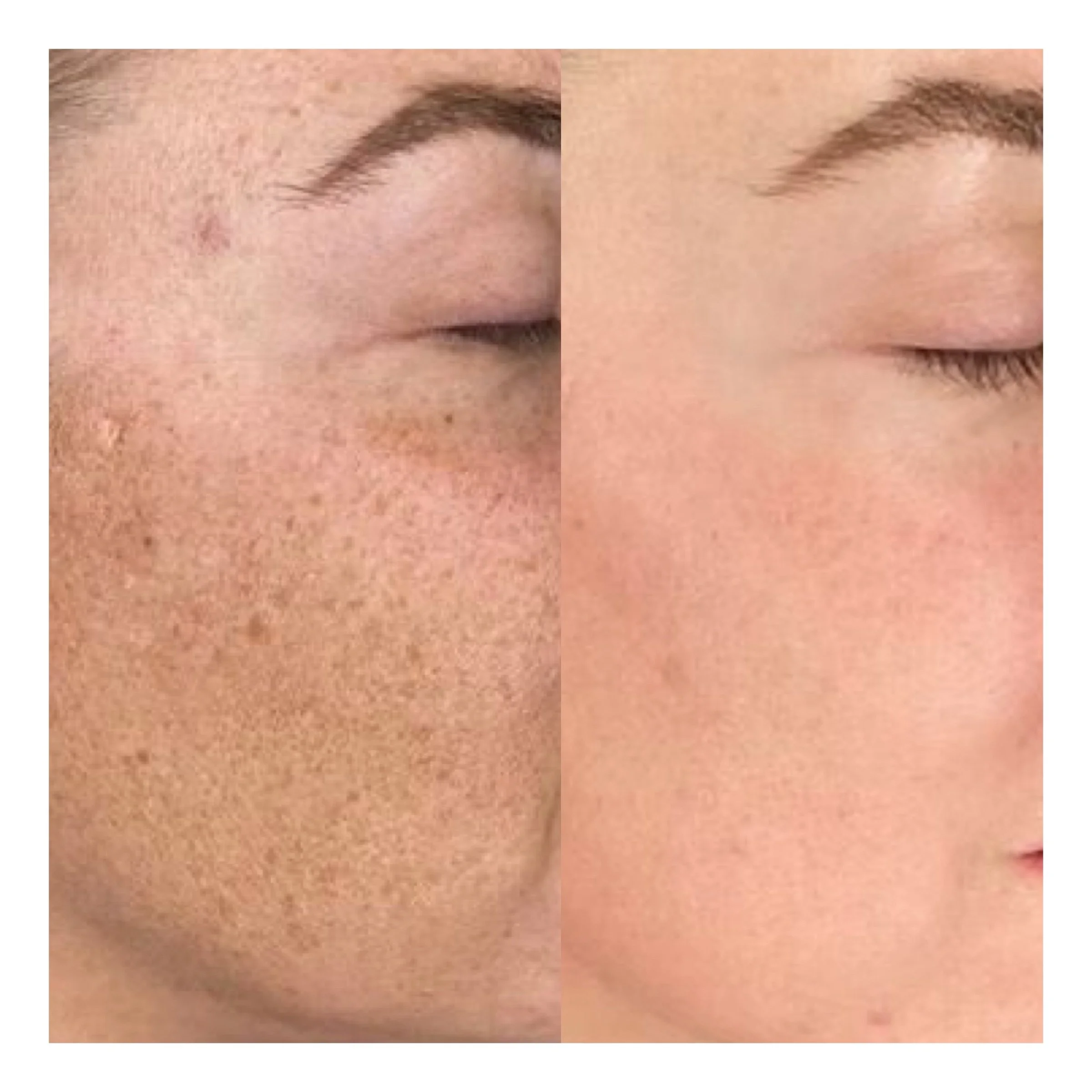 Microneedling Hamburg vorher nachher bei Pigmentflecken und klarerer Haut
