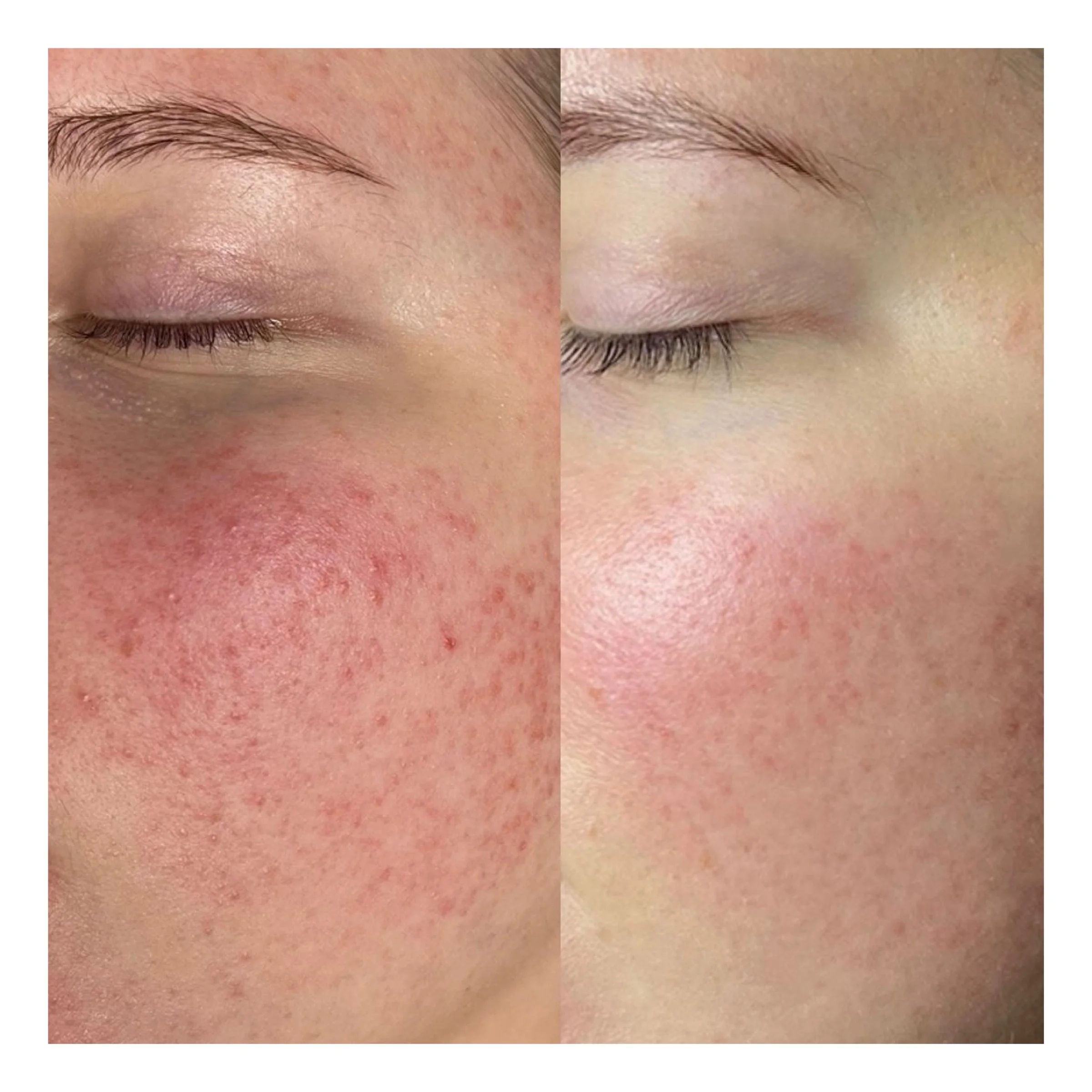 Radiofrequenz Microneedling Hamburg Ergebnis bei Rosazea und beruhigter Haut