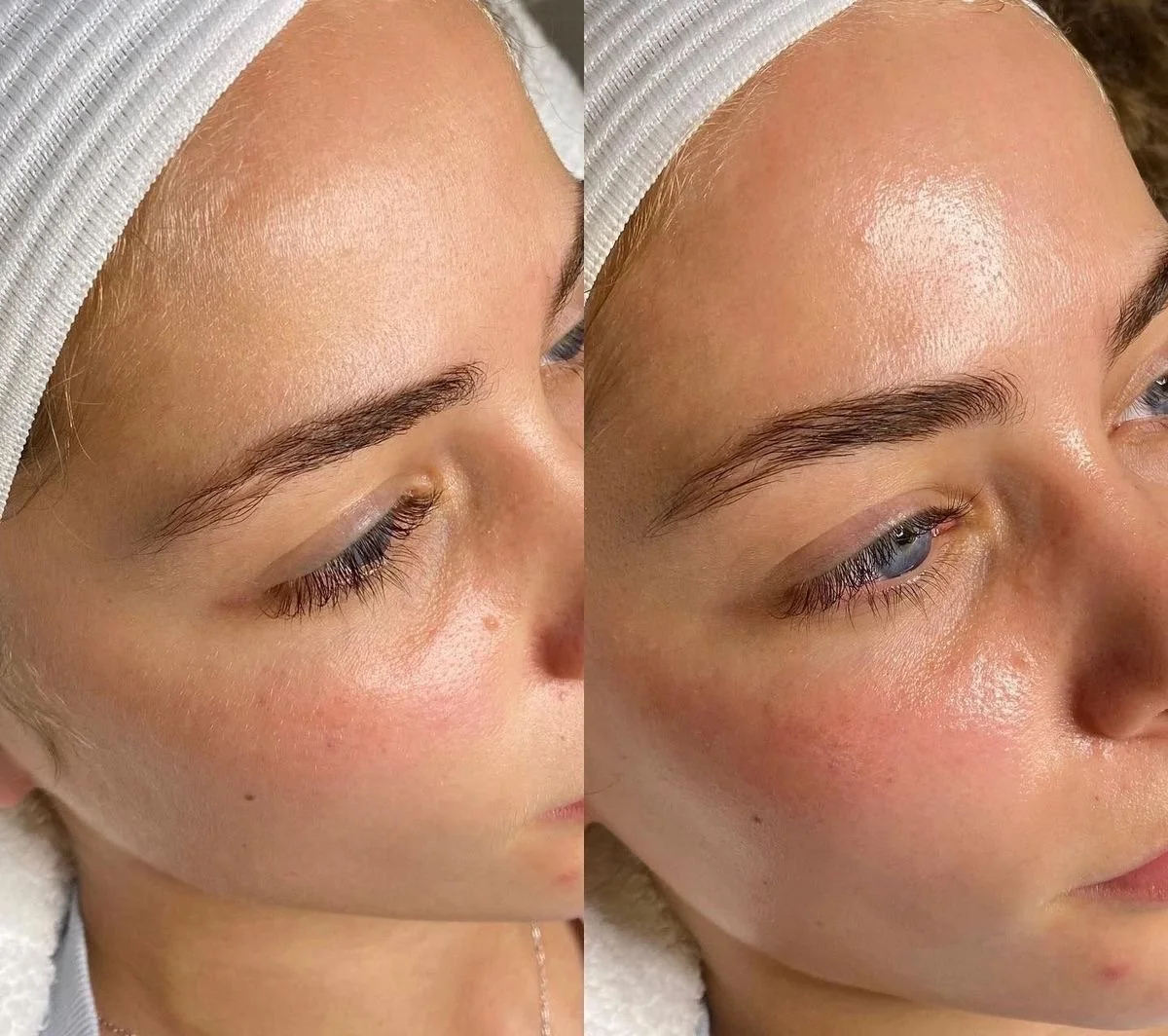 Hydrafacial Vorher-Nachher Ergebnis mit verfeinerter Hautstruktur und strahlendem Glow
