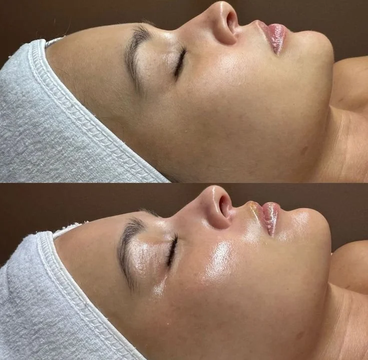 Hydrafacial vorher nachher bei trockener Haut