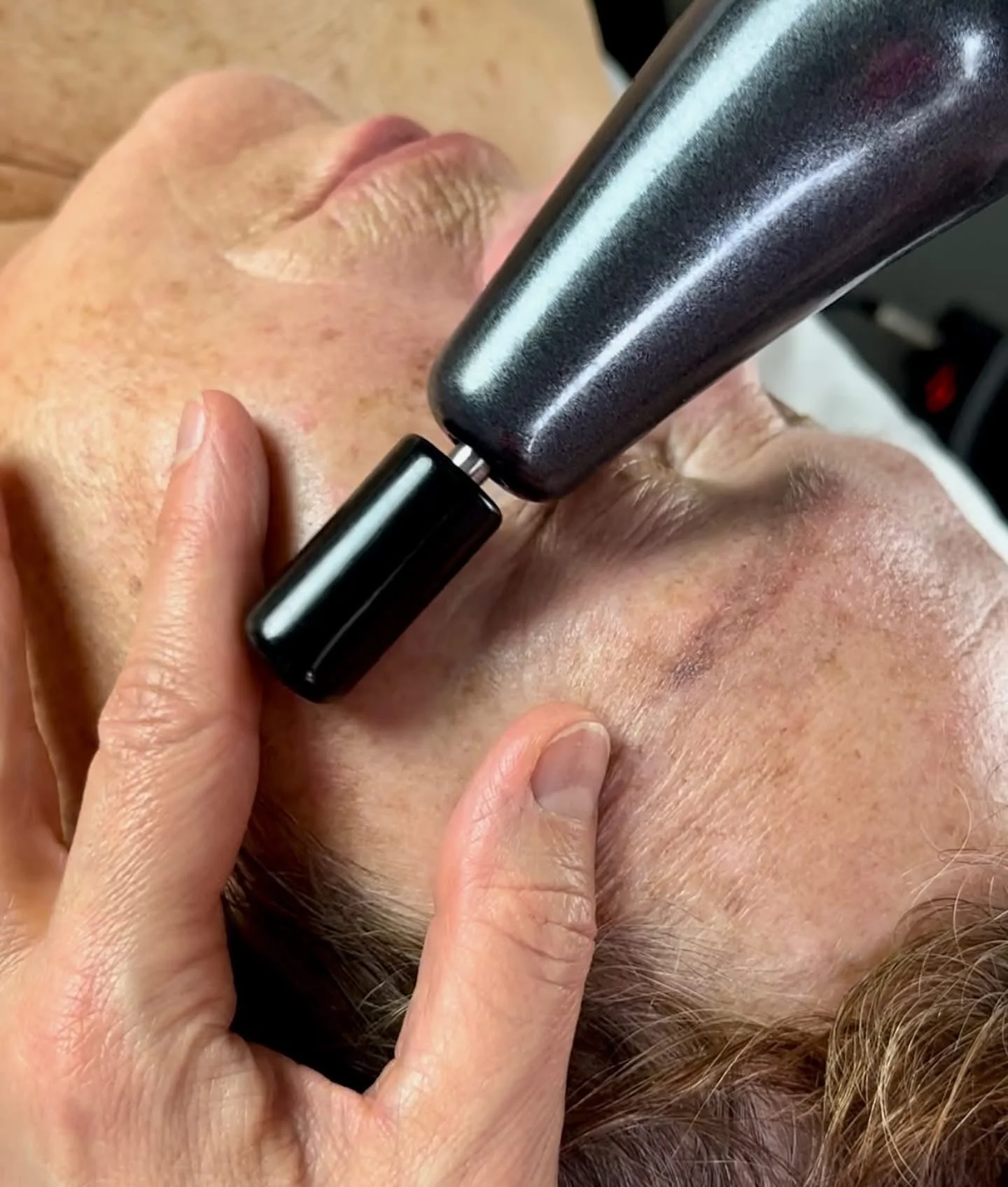 BMS-Gerät während der biomechanischen Gesichtsmuskel-Stimulation im Gesicht nach Professor Dr. Nazarov zur Aktivierung der Gesichtsmuskulatur und Unterstützung straffer Gesichtskonturen.