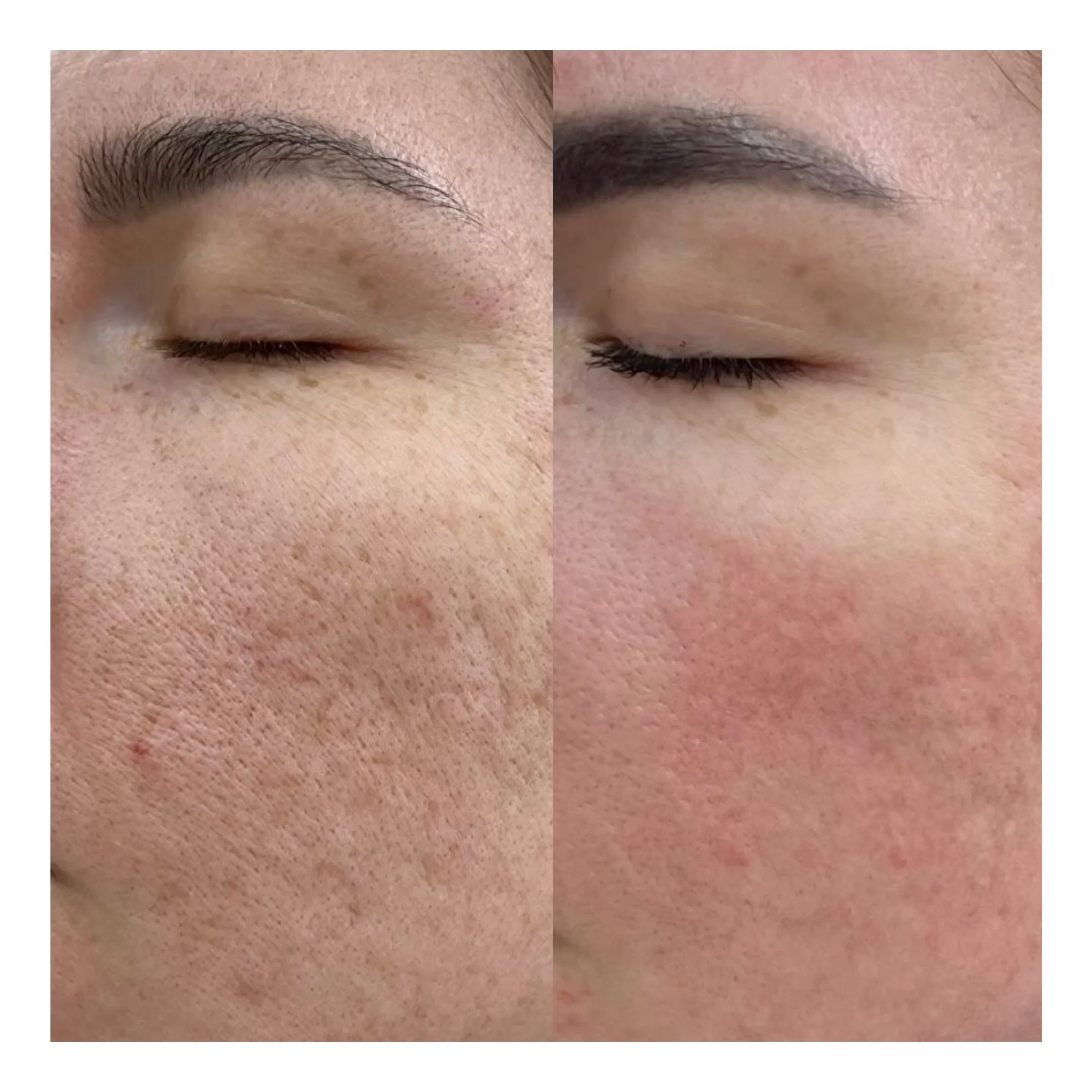 Aknenarben vorher nachher Microneedling Ergebnis glattere Hautstruktur