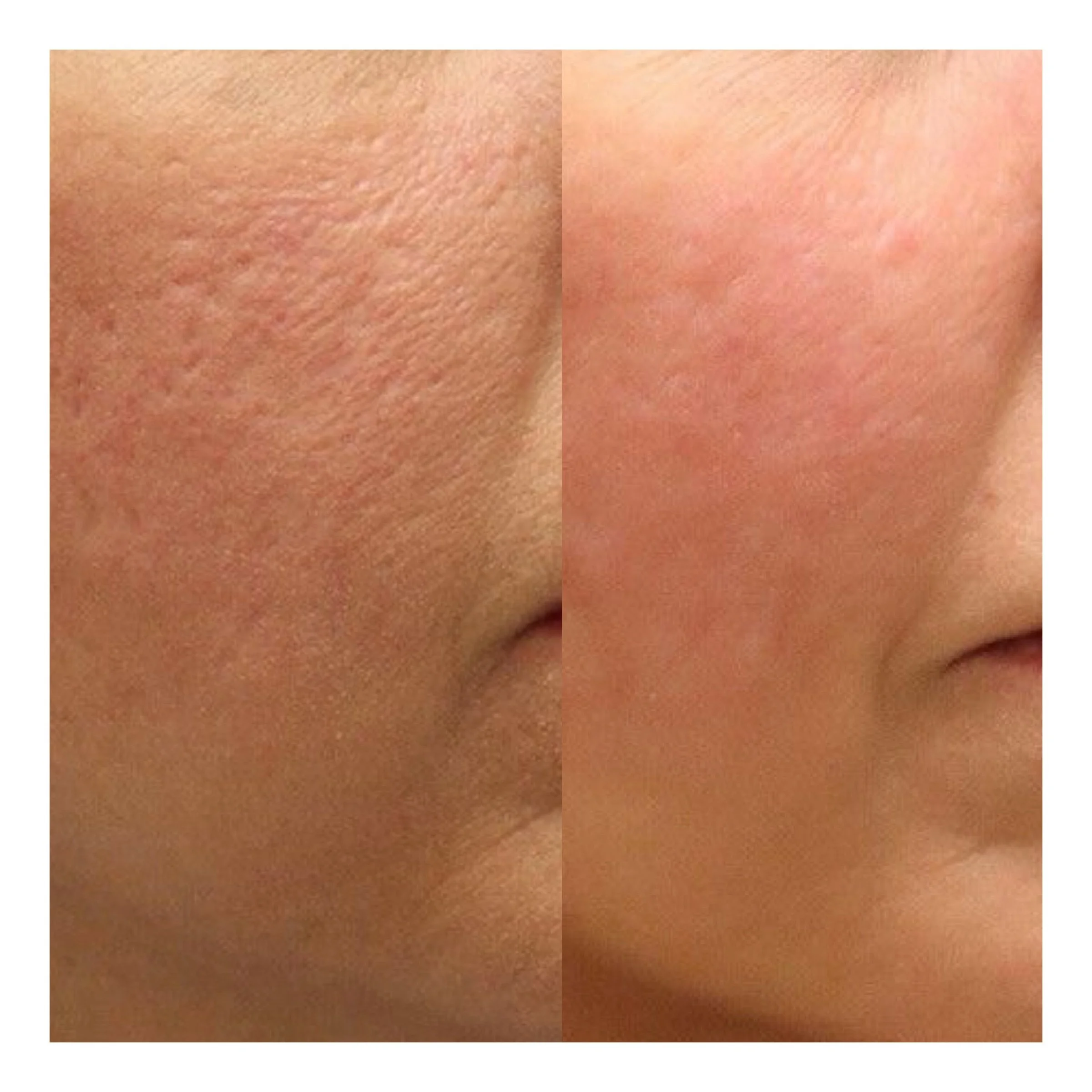 Microdermabrasion Hamburg Ergebnis mit verfeinerter Hautstruktur, glatter Haut und verbessertem Hautbild