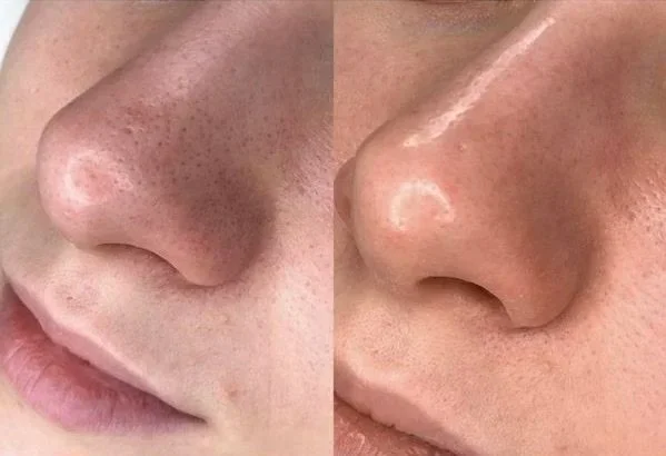 Hydrafacial vorher nachher. Ergebnis nach der ersten Behandlung