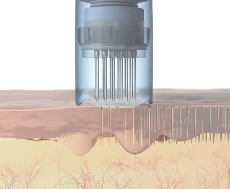 Microneedling in der Haut: Mikrokanäle stimulieren die natürliche Kollagenbildung und Hautregeneration