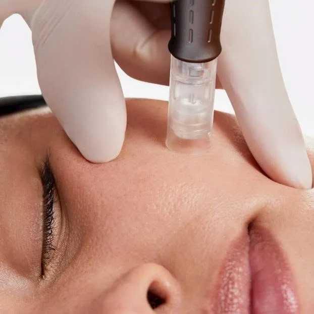 Professionelle Microneedling-Behandlung mit individueller Hautberatung zur Unterstützung der Kollagenbildung und Hautregeneration