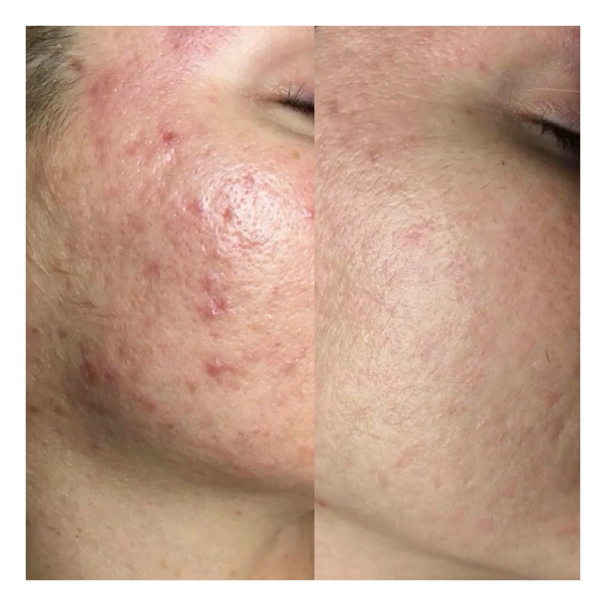Radiofrequenz Microneedling Hamburg Ergebnis mit weniger Aknenarben und klarerer Haut