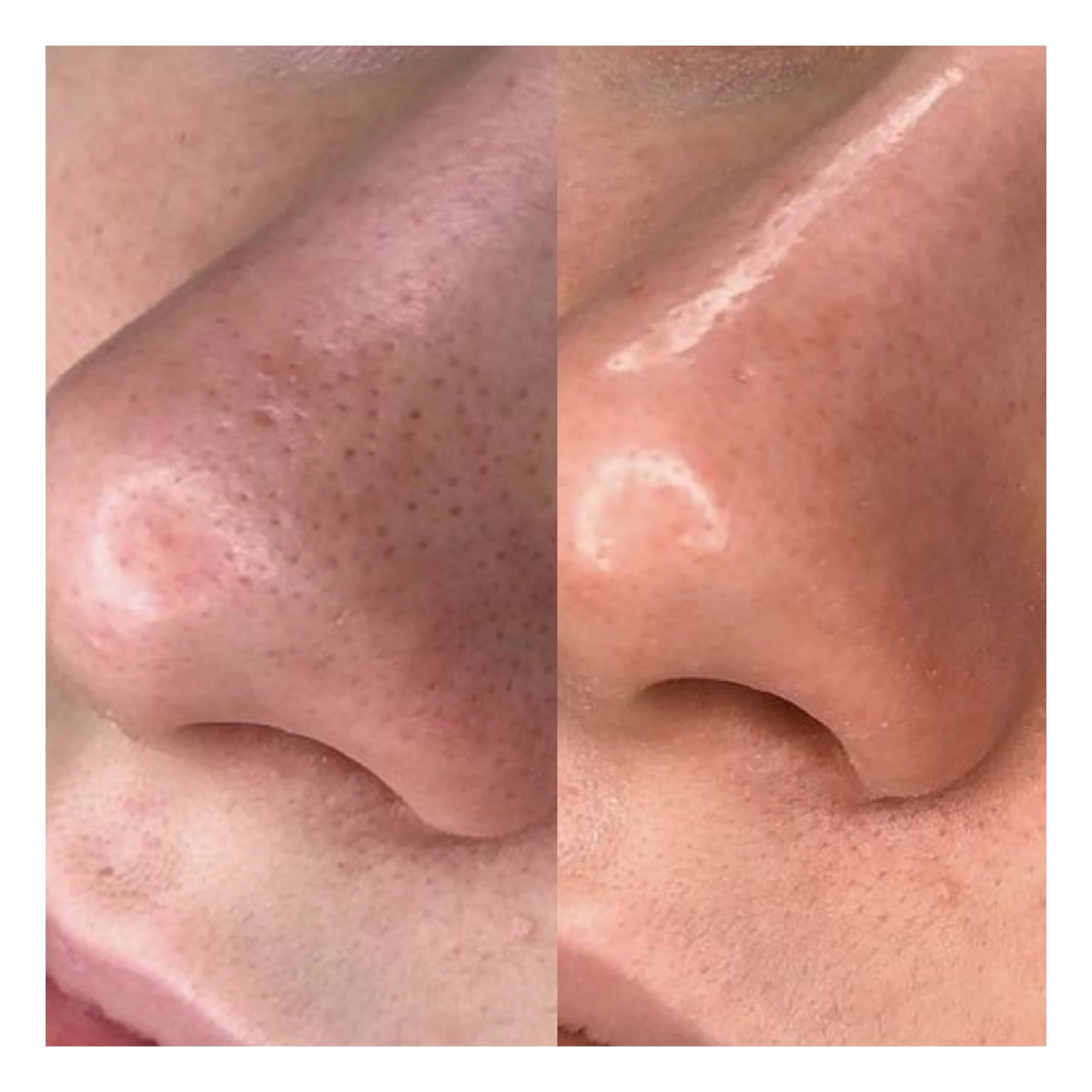 Hydrafacial Hamburg vorher nachher Poren gereinigt und Haut verfeinert