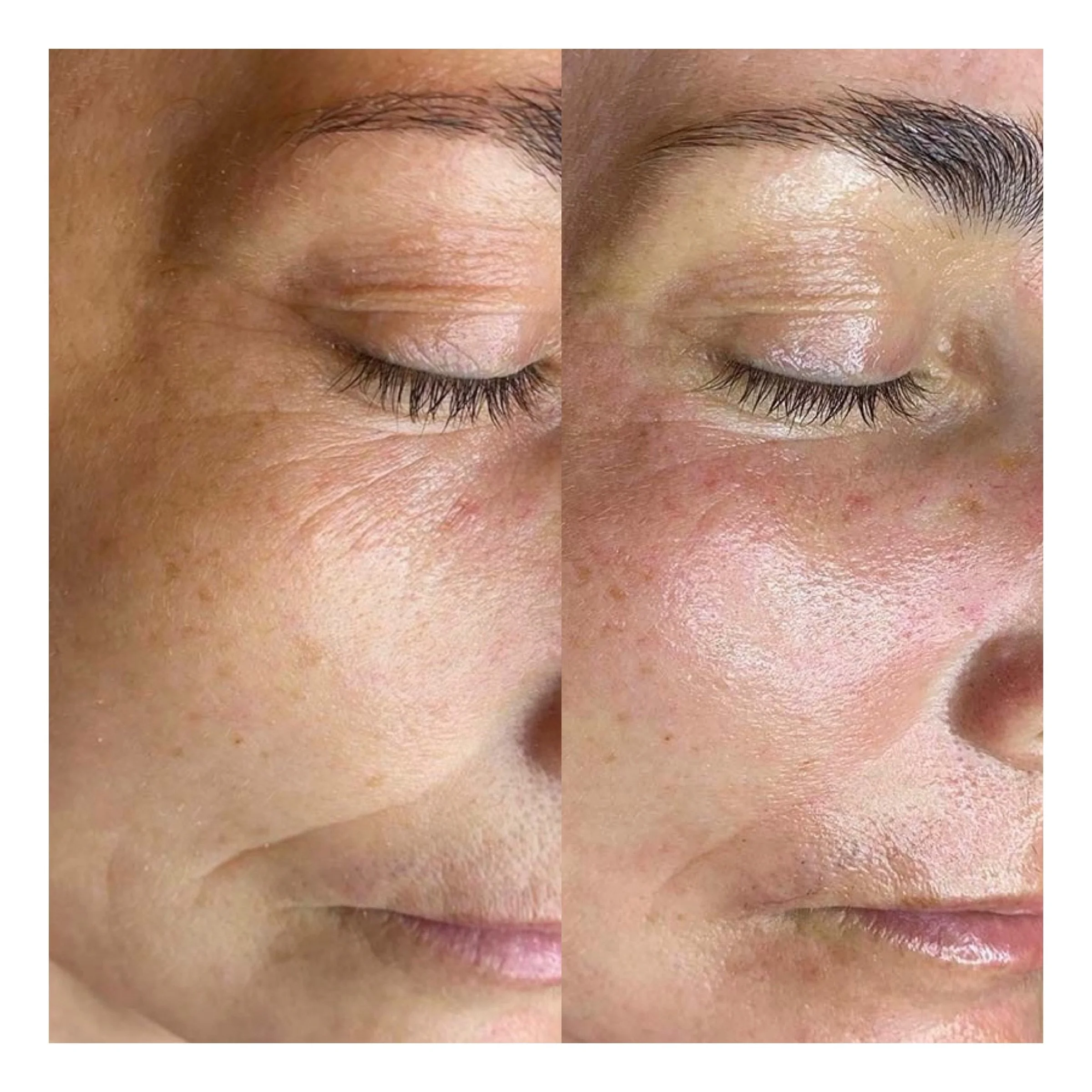 Microneedling Hamburg Ergebnis mit glatter Haut und verfeinertem Hautbild