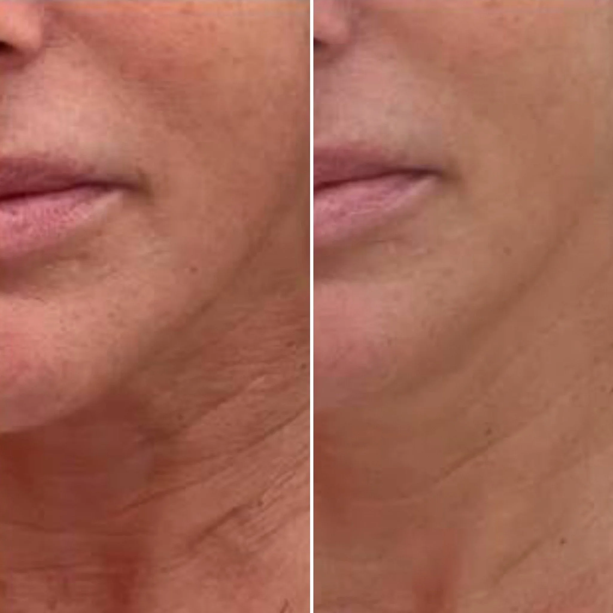Vorher-Nachher-Ergebnis nach einer Kur mit biomechanischer Gesichtsmuskel-Stimulation nach Professor Dr. Nazarov – definiertere Gesichtskonturen, strafferes Hautbild und frischere Ausstrahlung.