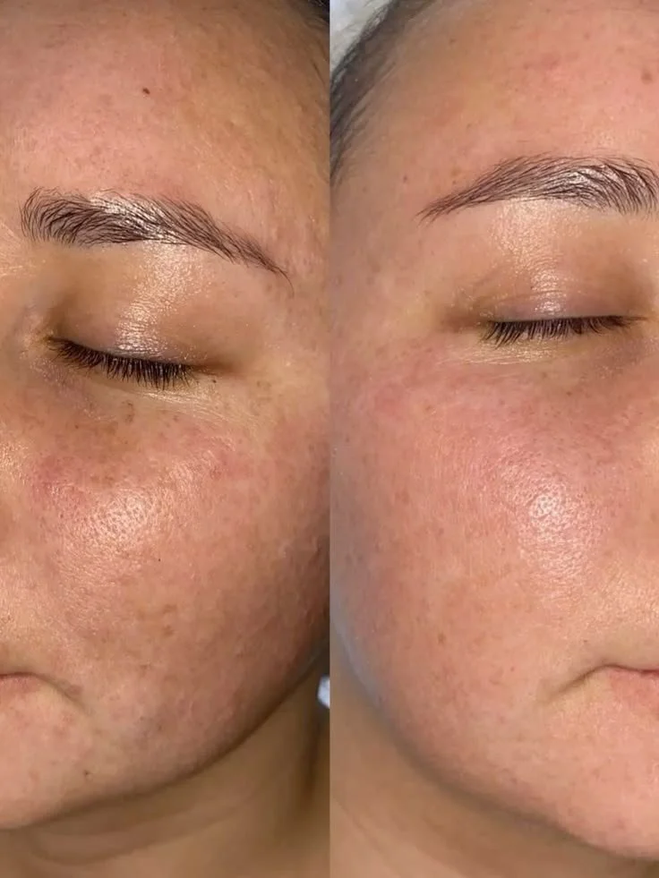 Microneedling Vorher-Nachher mit weniger Falten und Pigmentflecken