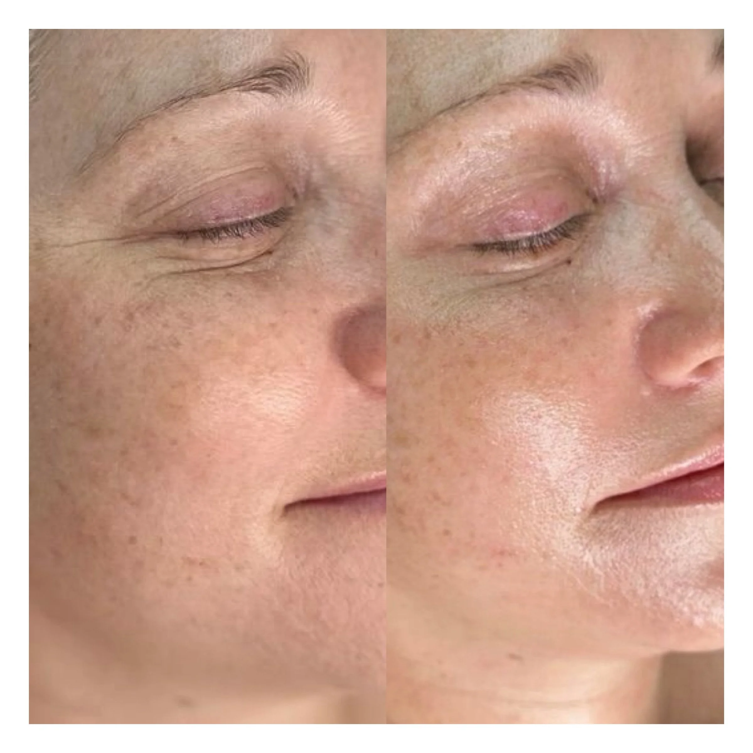 Hydrafacial Hamburg Ergebnis mit glattem frischem Teint