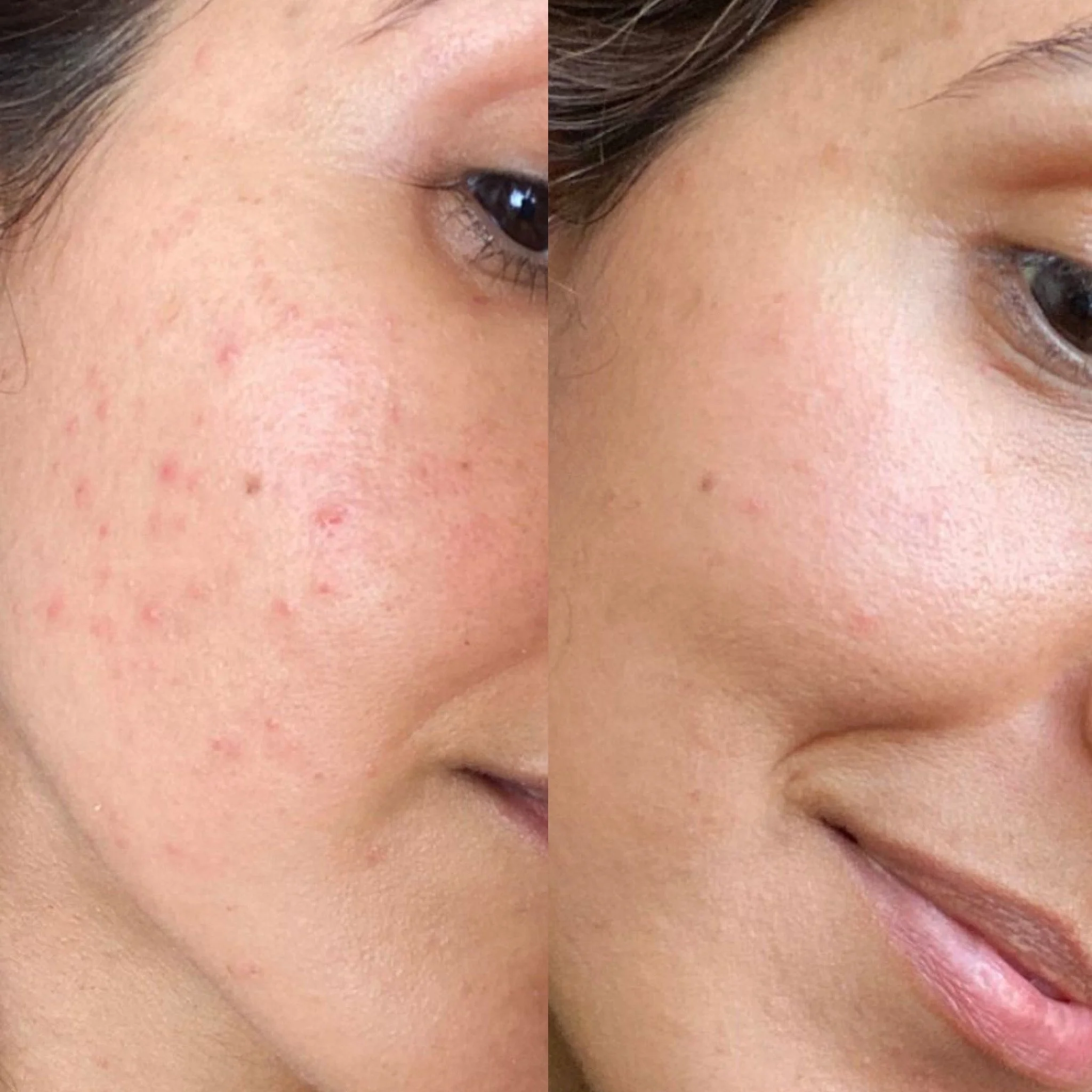 Professionelles RF Microneedling in Hamburg – sichtbare Verbesserung des Hautbildes