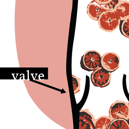 Deep Vein Thrombosis