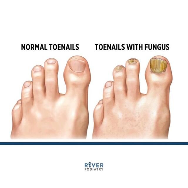 Infected toenails with fungus may have the following characteristics: ⁠
⁠
- thicker than usual⁠
- separated from the nail bed⁠
- discolored⁠
- distorted in shape⁠
- ragged⁠
⁠
Speak with us today (link in bio) if you feel that you may be suffering fro