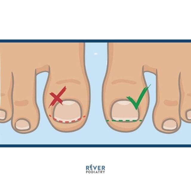 Here is a side by side comparison on how to properly trim your toenails. Click the link in our bio to learn more #RiverPodiatry⁠
⁠