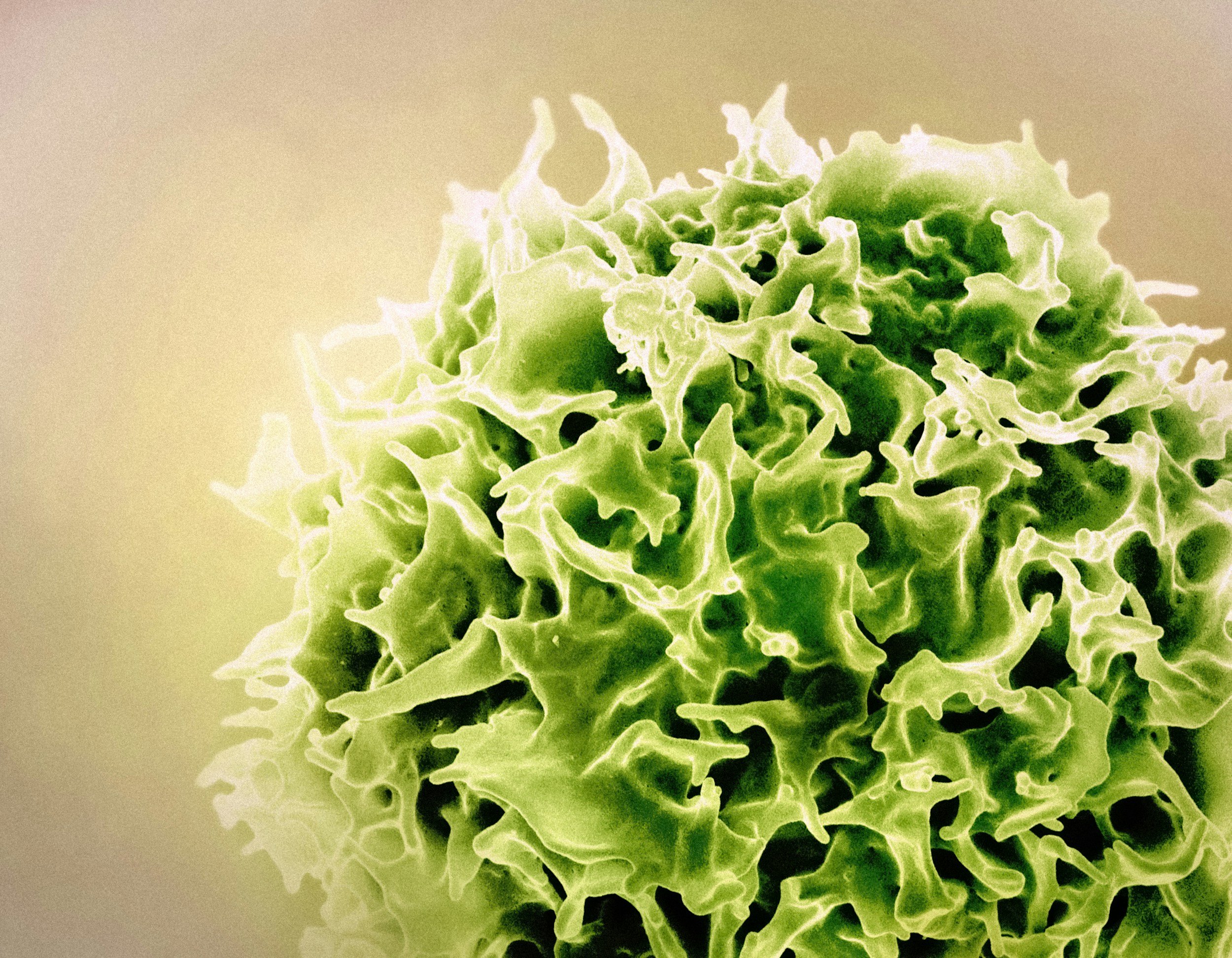 Angioimmunoblastic T-Cell Lymphoma: A Guide to the Disease and SSDI Eligibility