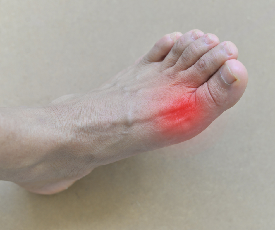 Everything You Need To Know About Gout — Advanced Feet & Ankle Care