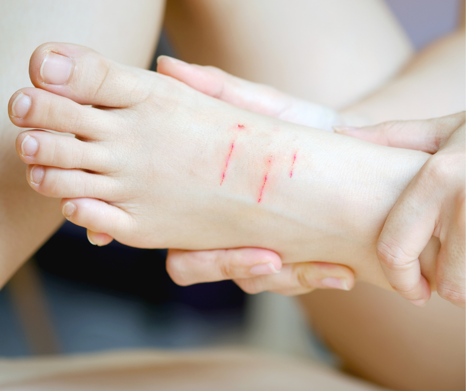 Guide to Diabetic Ulcers (And a New Clinical Trial!)