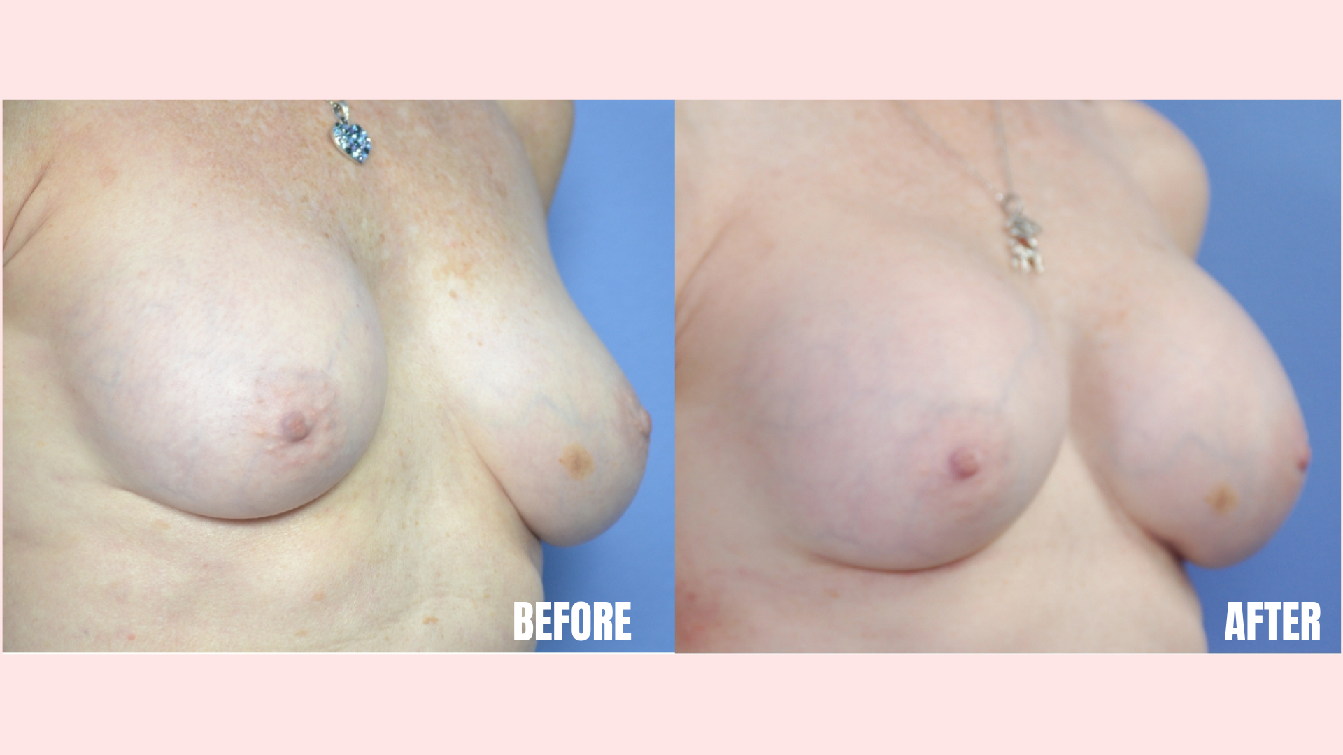 Breast Augmentation