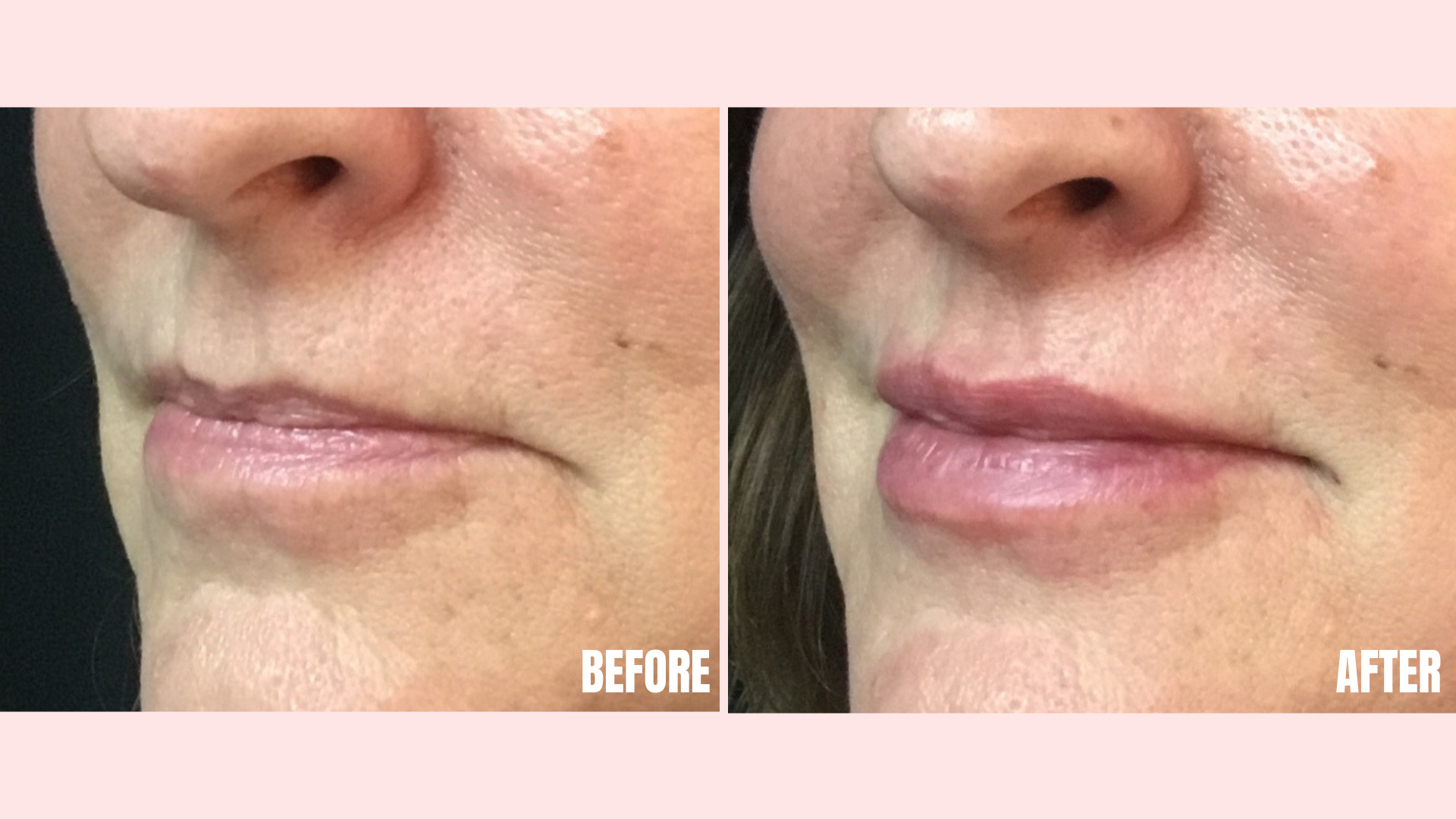 Filler in Lips