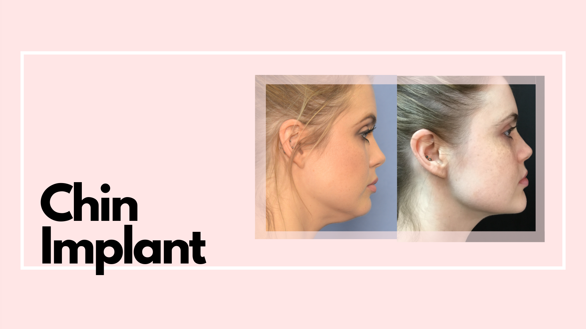 Restore balance to your face while also chiseling your jawline. This is a small procedure with a big payout. The difference Dr. Miles sees in his chin augmentation patients is huge! Create definition, symmetry, and youth with a chin augmentation.