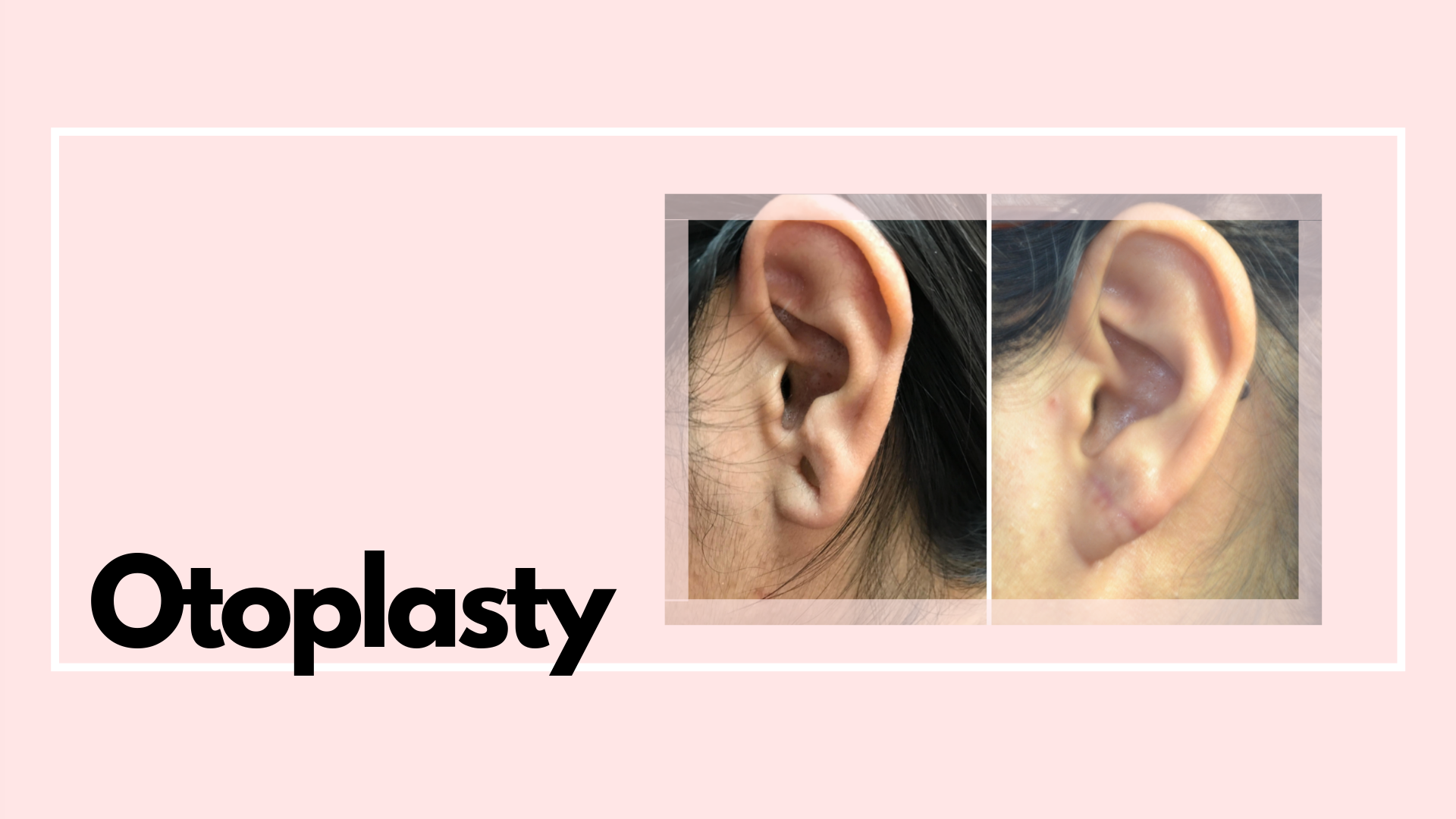 This procedure is used to reduce the size of large ears or pin back ears that stick out to far.